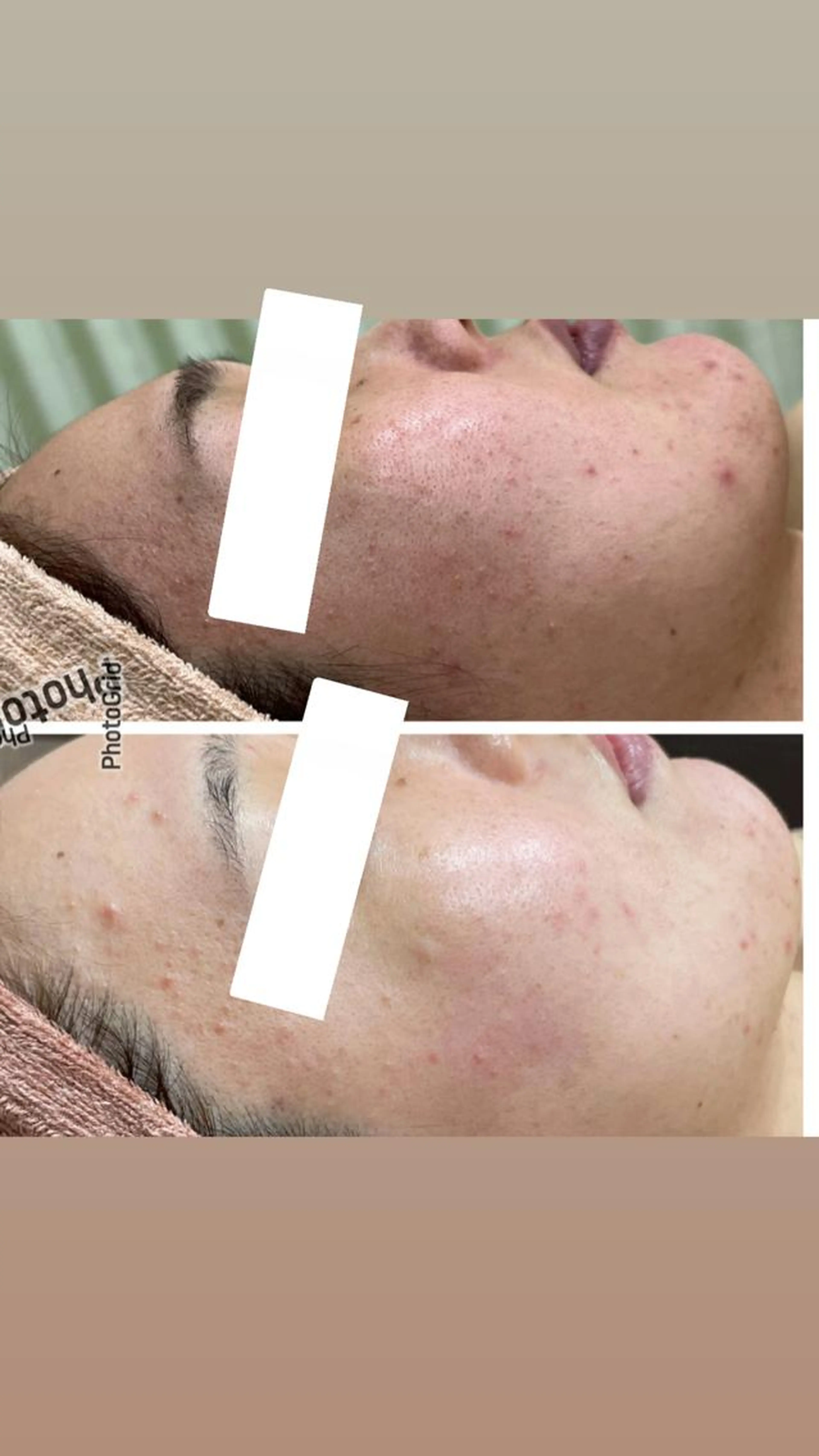 肌診断付【韓国で大人気水光肌✨️】水光ピール✨毛穴レス、繰り返すニキビなど、憧れのツヤ感水光肌へ💕の写真