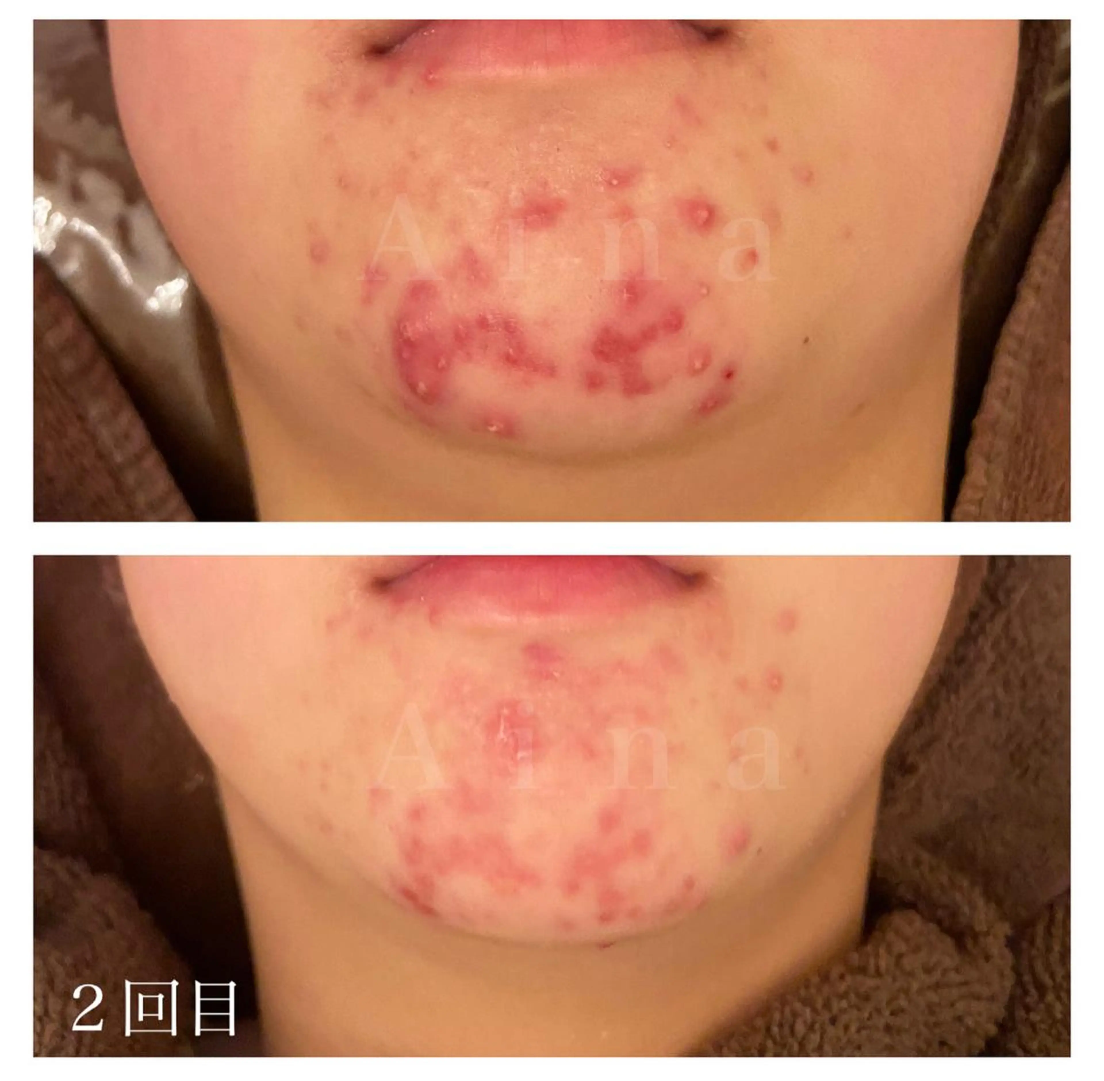 セミロング メンズ キッズ ネイル マツエク・マツパ アイブロウ 赤色 エステ リラク ニキビ跡専門サロン Ａｉｎａのエステ・リラクイメージ