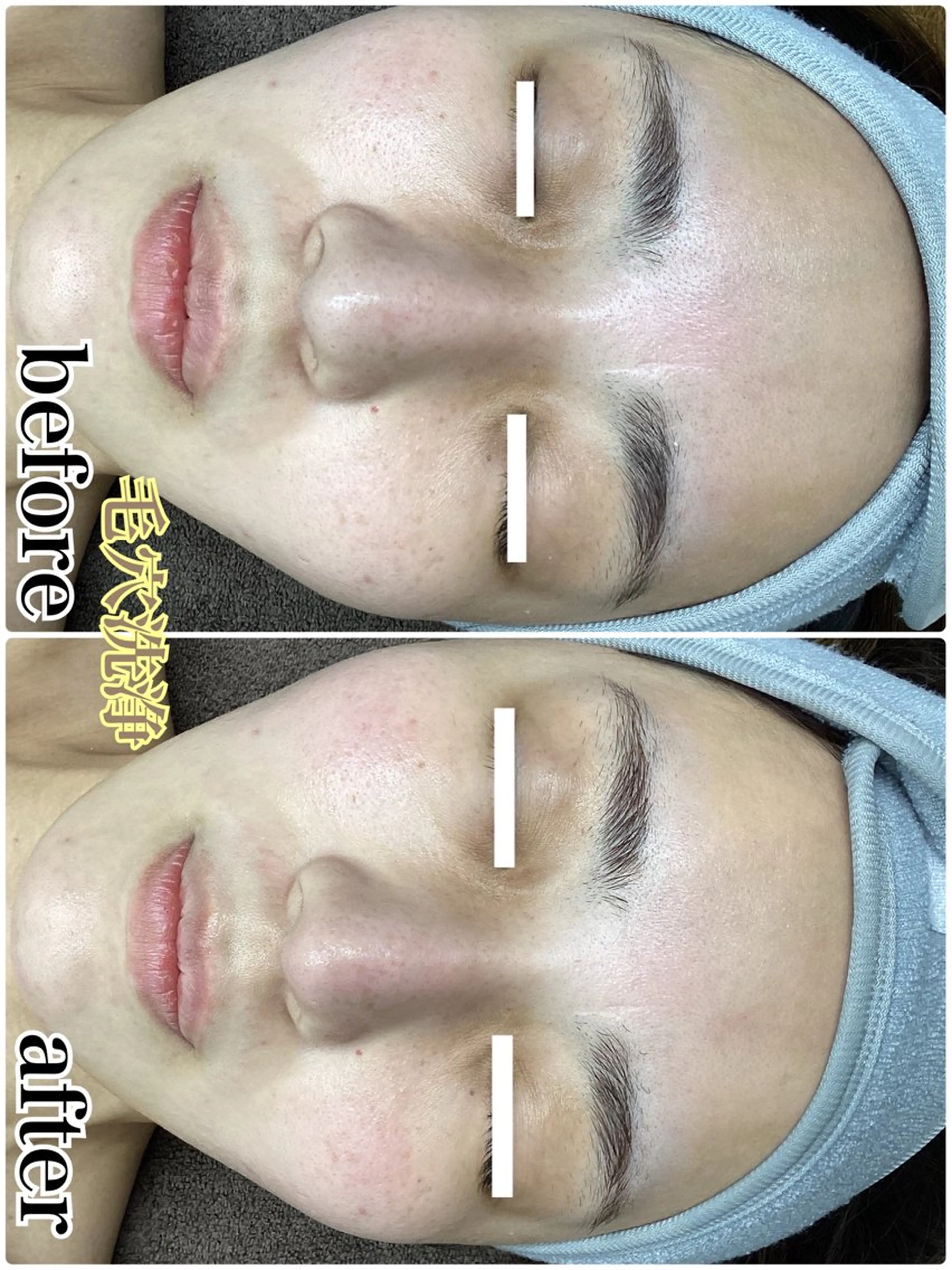 最新美肌脱毛 韓国水光肌🫧のその他イメージ