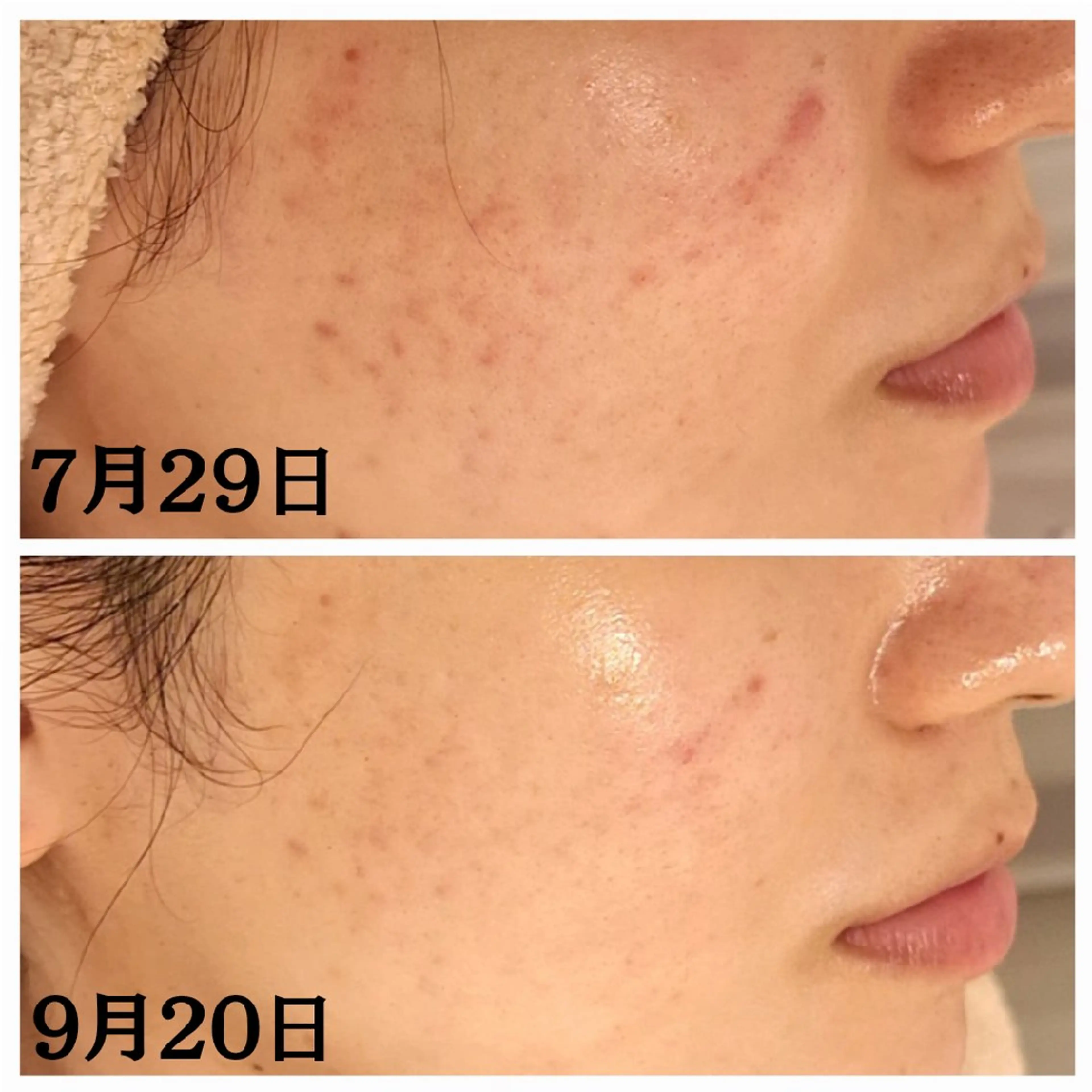 ハーブピーリング+高濃度美容液導入　60分　￥3,300オフの写真