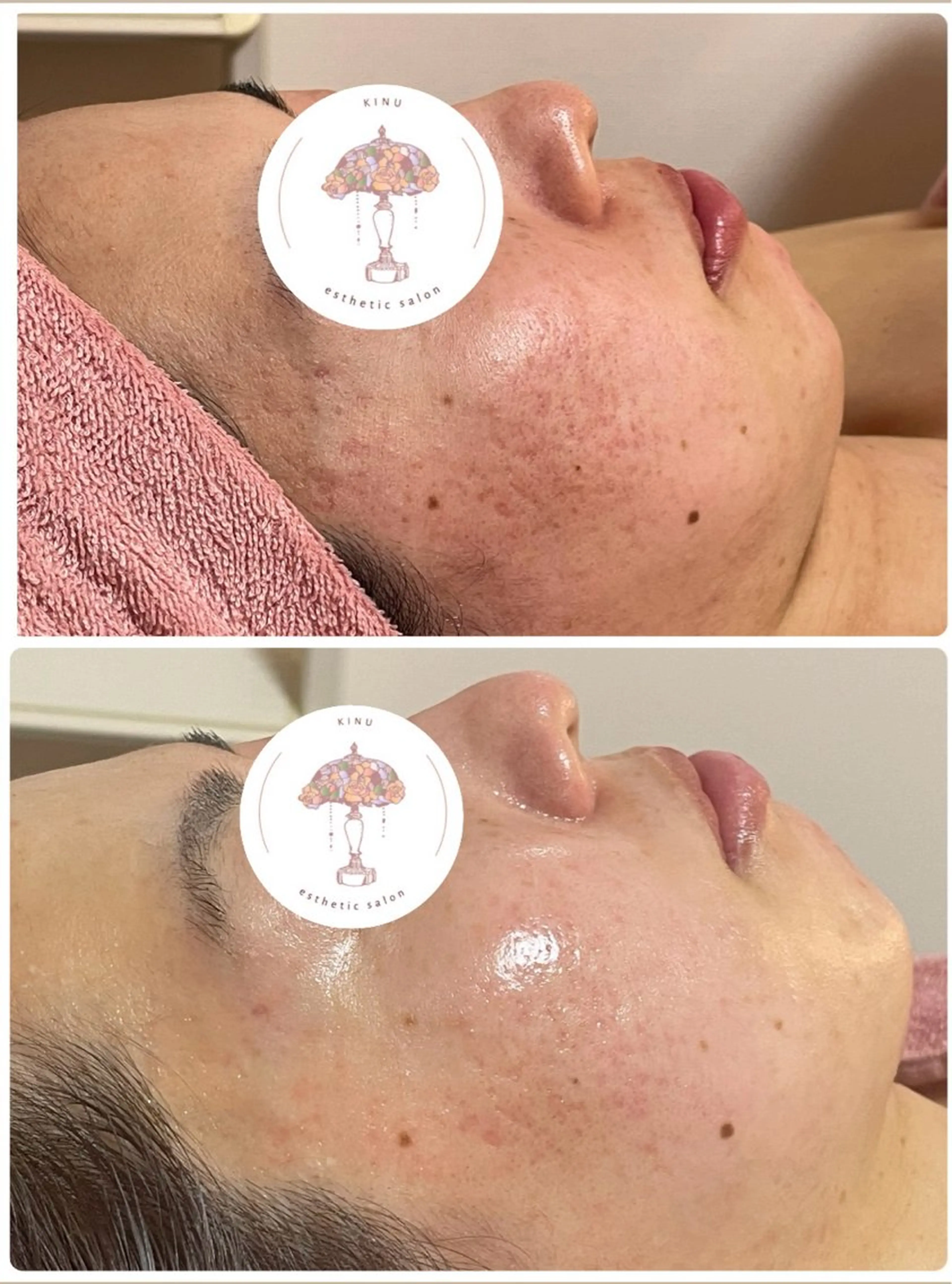 【ニキビ悩み】ハーブピーリングの写真