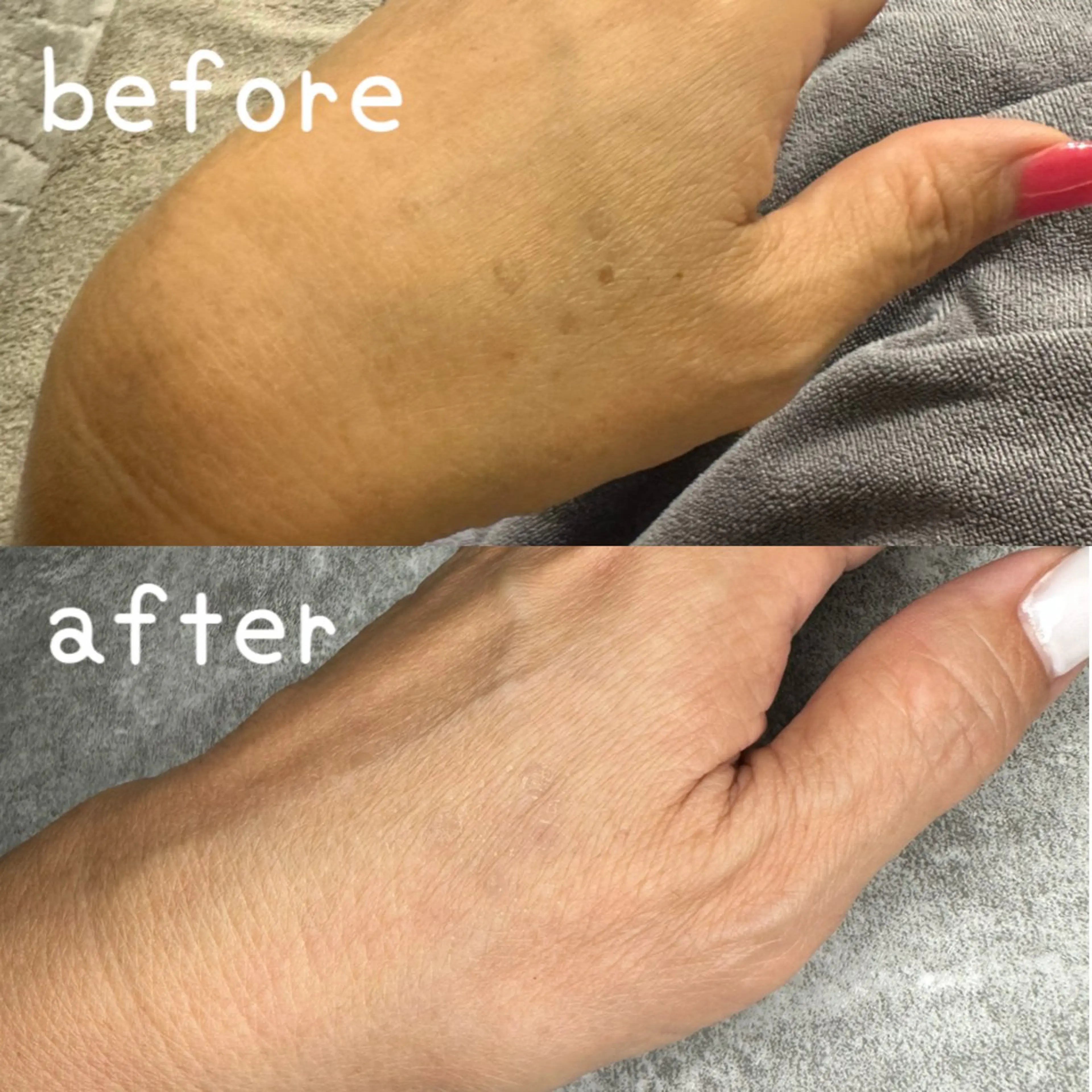 【ハンド】光ハンドケア 光フェイシャルでシミ・しわ・くすみ同時に効果があり、お肌のお悩み解決！透明感のある印象に！！の写真