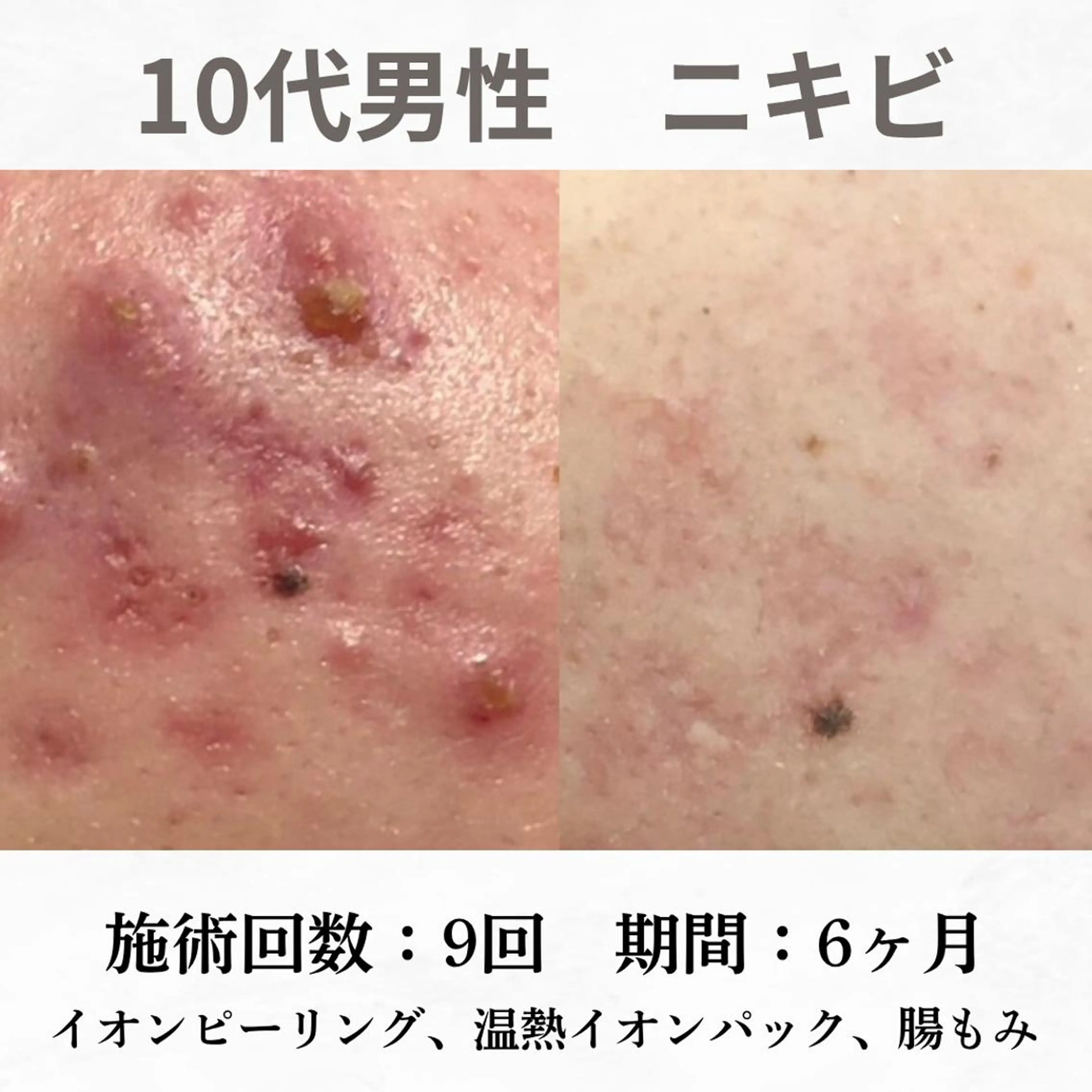 重度ニキビ専門🌷 ダウンタイムなしのエステ・リラクイメージ