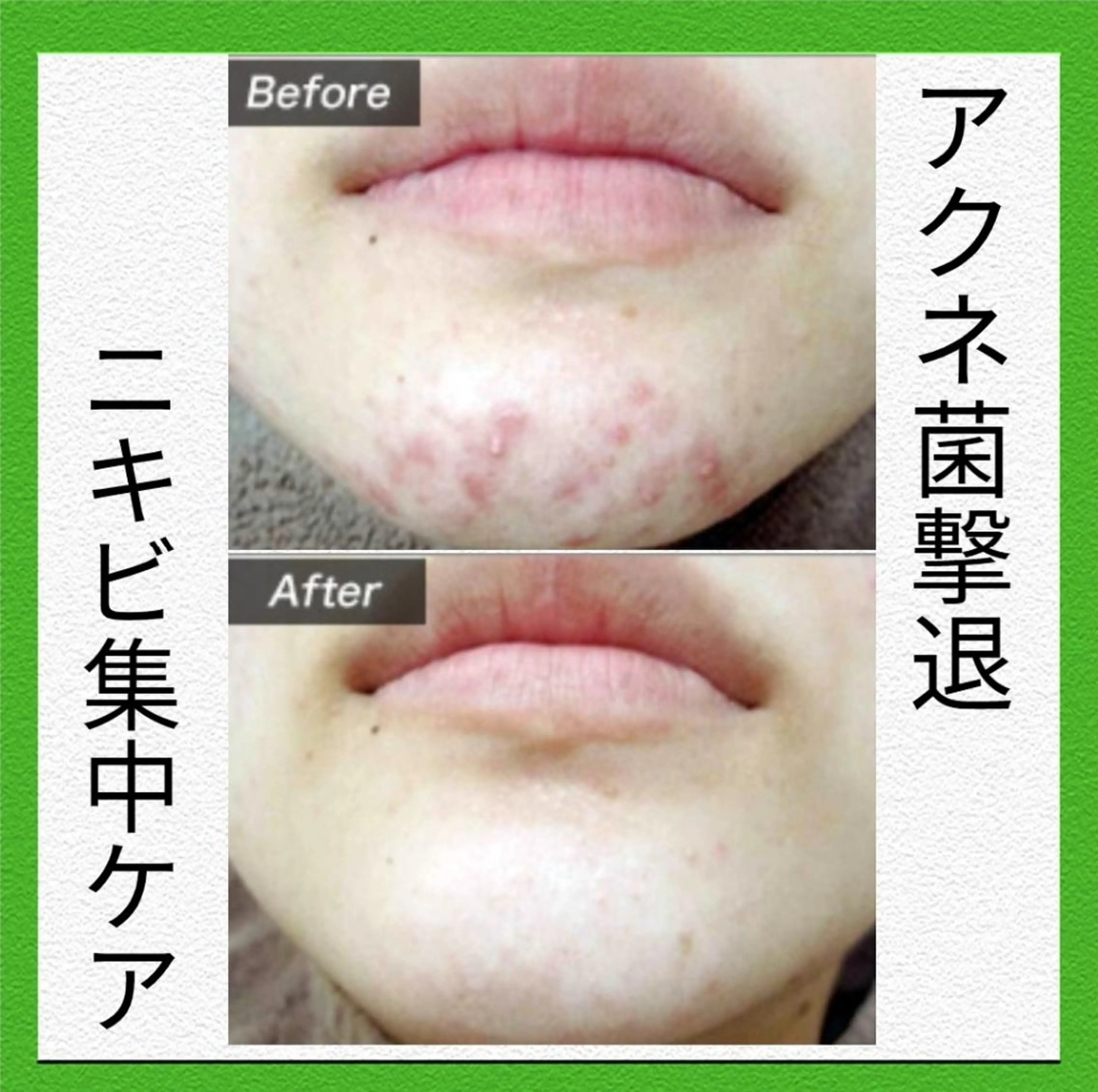 【アクネ菌撃退👊‼️ニキビ集中ケアコース】 60分 お土産パック付き🤍の写真