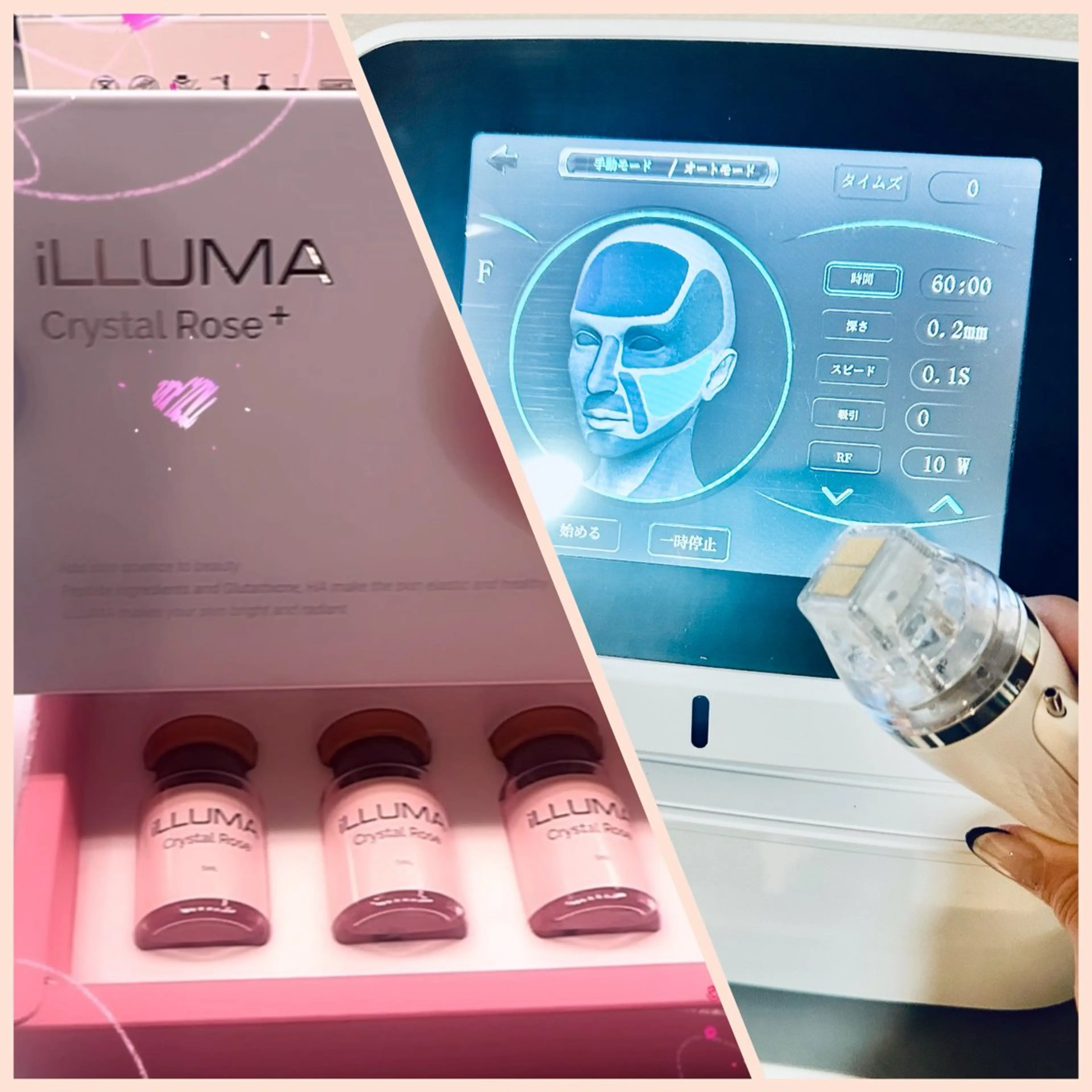 ★本気の肌質改善｜韓国式水光ポテンツァ再生コース★の写真