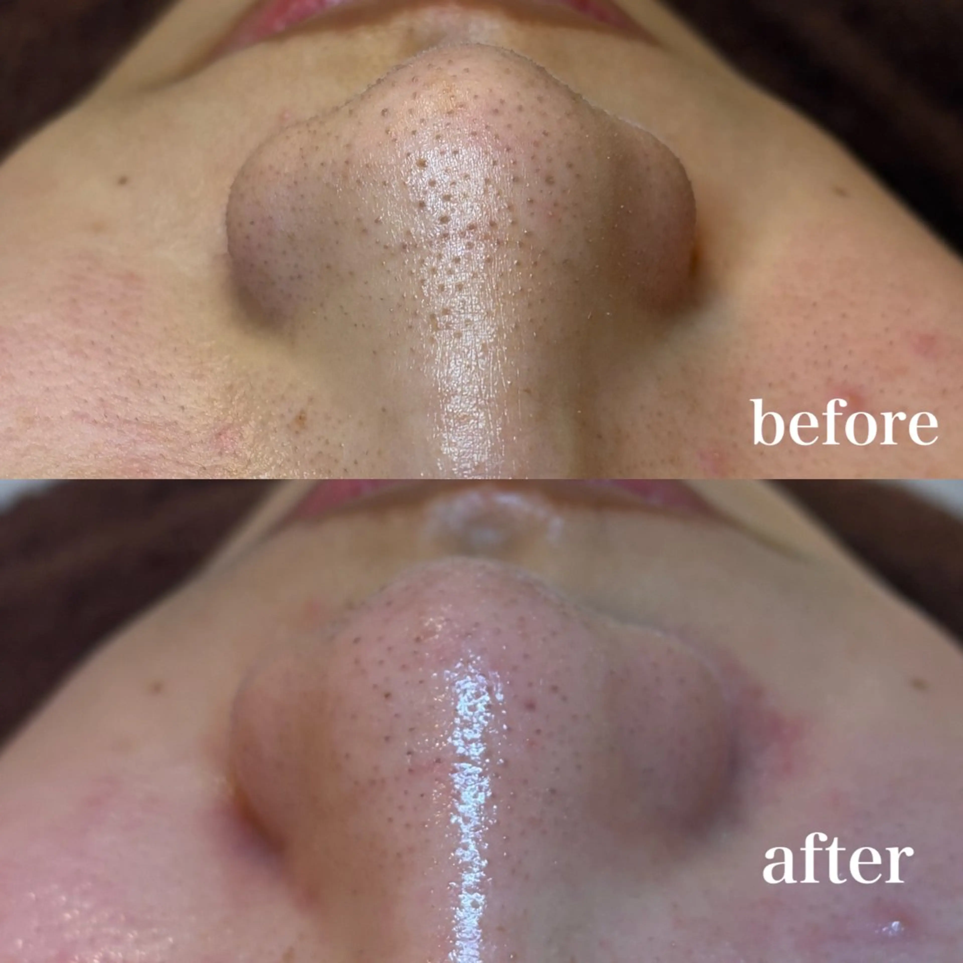 🫧ハイドラフェイシャル（毛穴洗浄）🫧先着10名限定価格　❗️動画撮影可能・口コミ記載❗️の写真