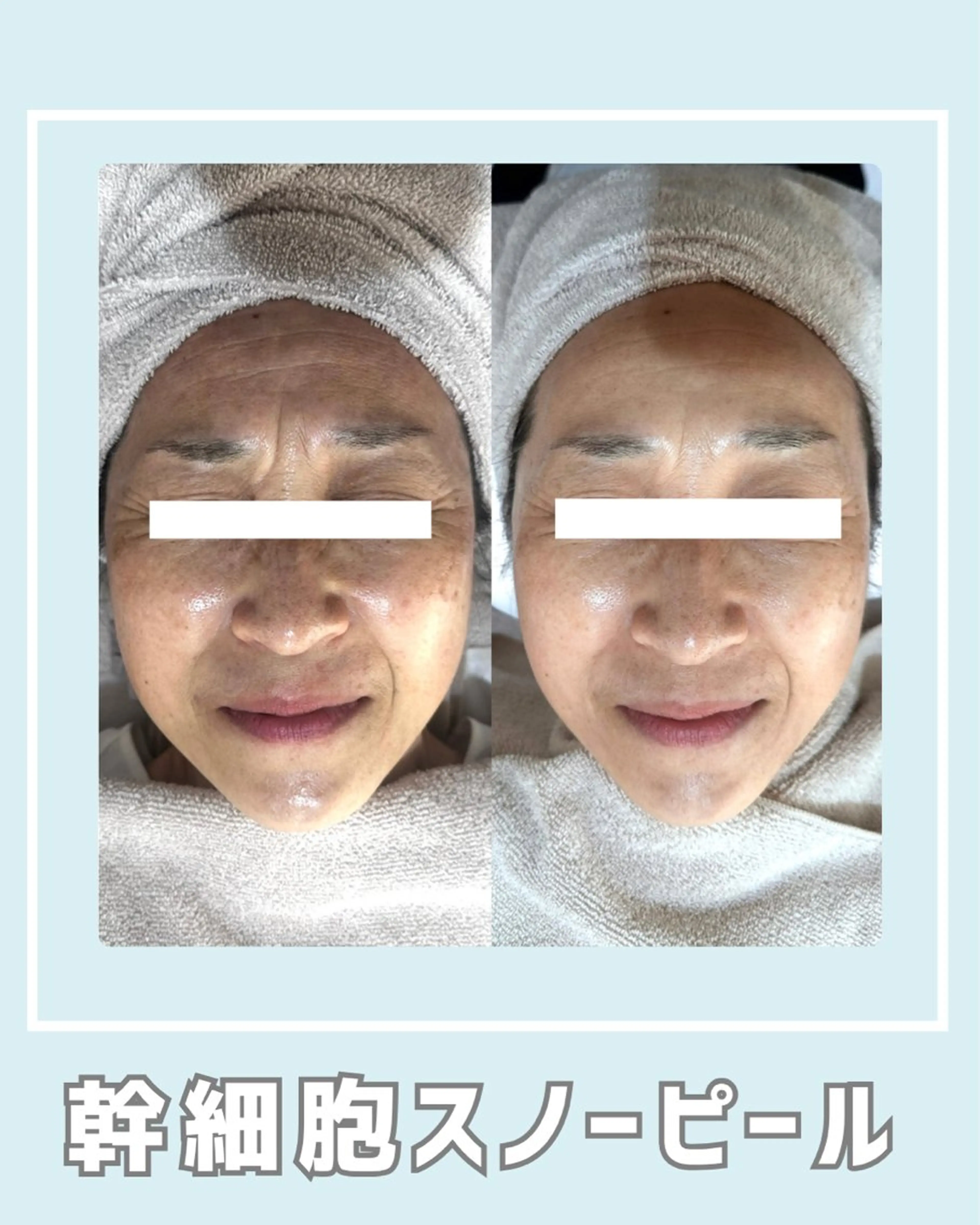 エステ |ピーリング・毛穴| soina神楽坂のエステ・リラクイメージ