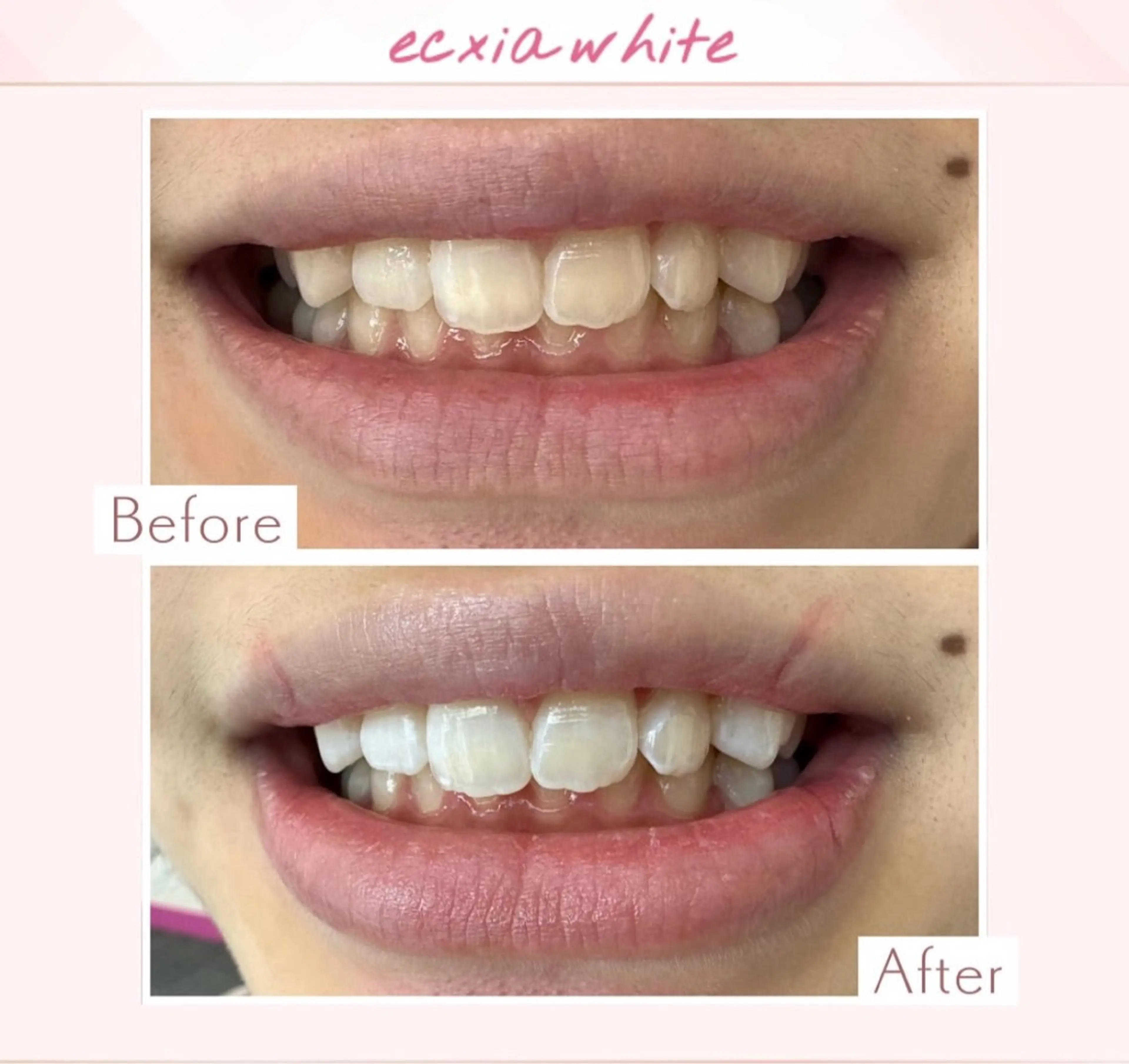 yumi❤︎ ホワイトニングのその他イメージ