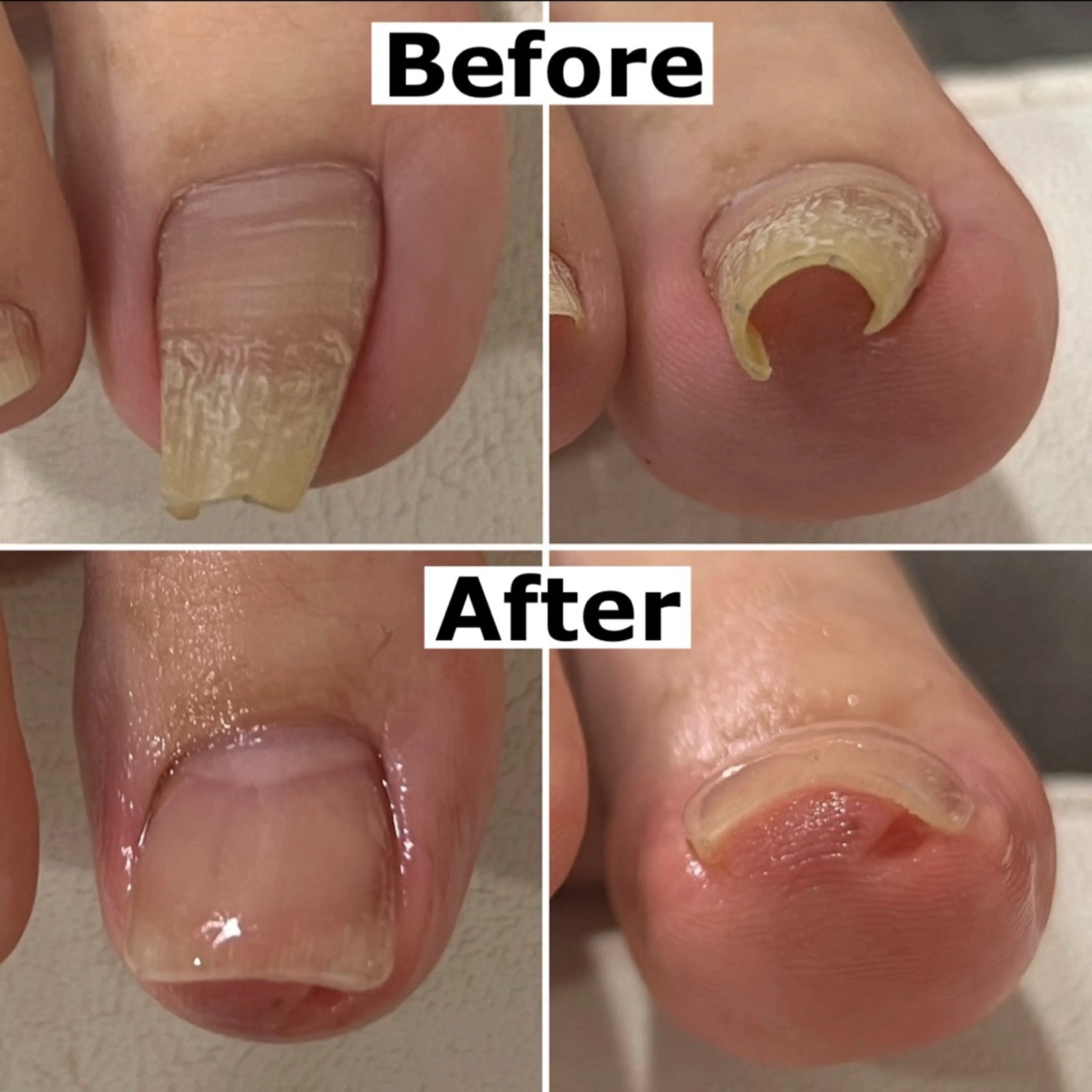 ネイル 巻爪無料モデル募集 ✨🦶MEGUMIのネイルデザイン