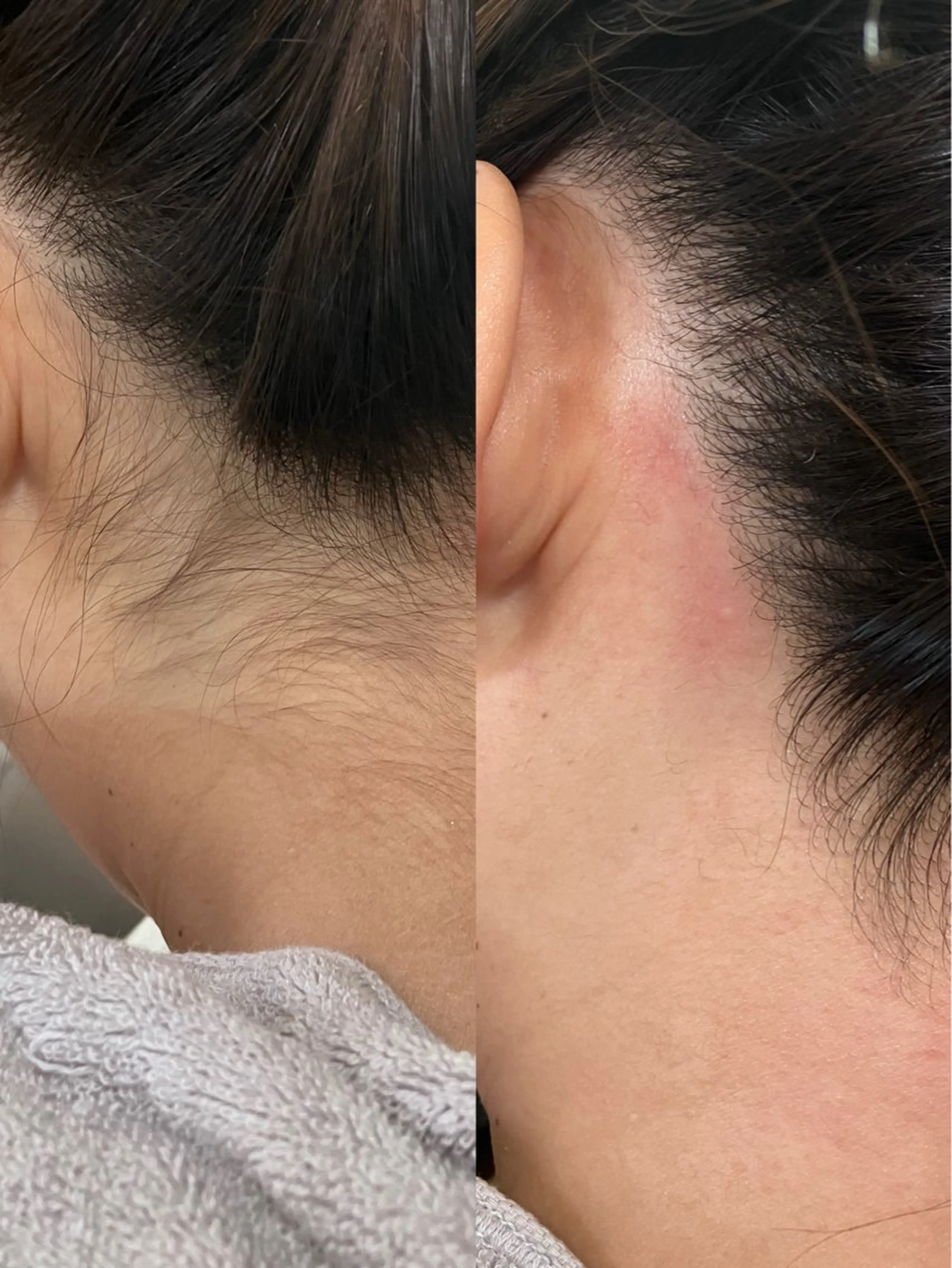 パーツwax🪄『うなじ』•『おでこ』•『もみあげ』いずれか1箇所wax🍯🪄の写真