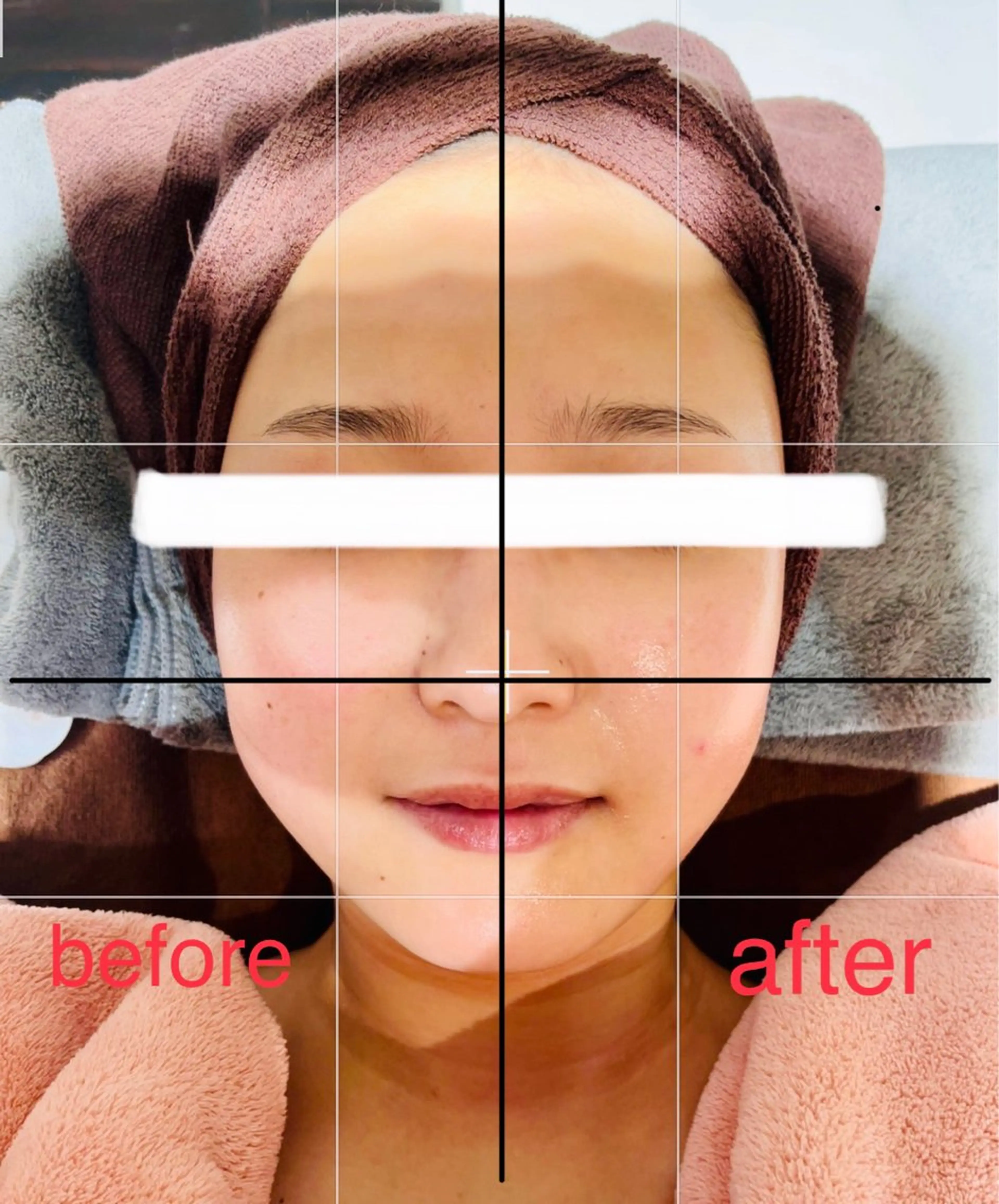 小顔美肌コース🎀サーマルFR+美肌パック+肌再生クリーム＋デコルテ～頭マッサージ付き🎀の写真