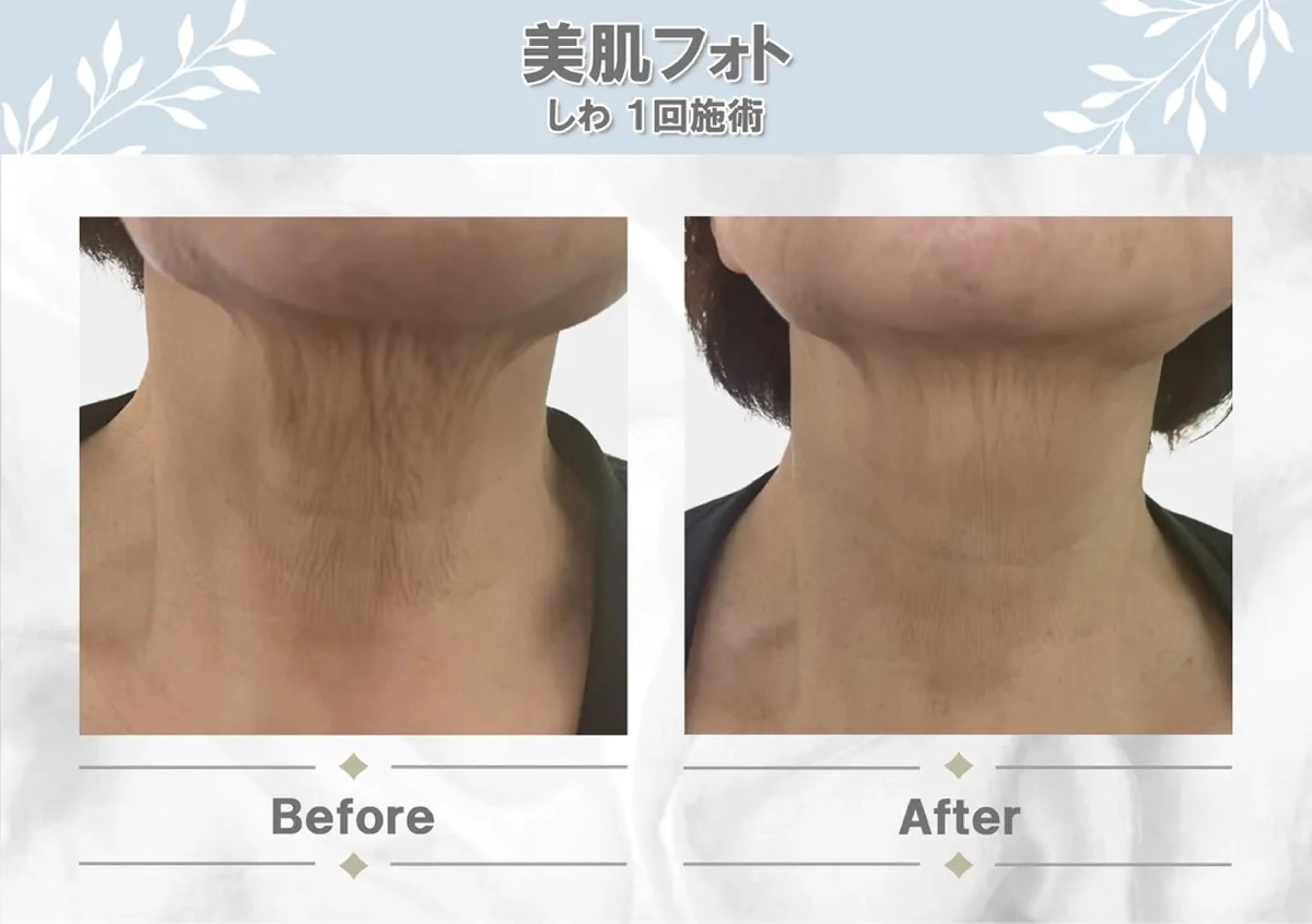 ✨美肌フォト✨首🦋の写真