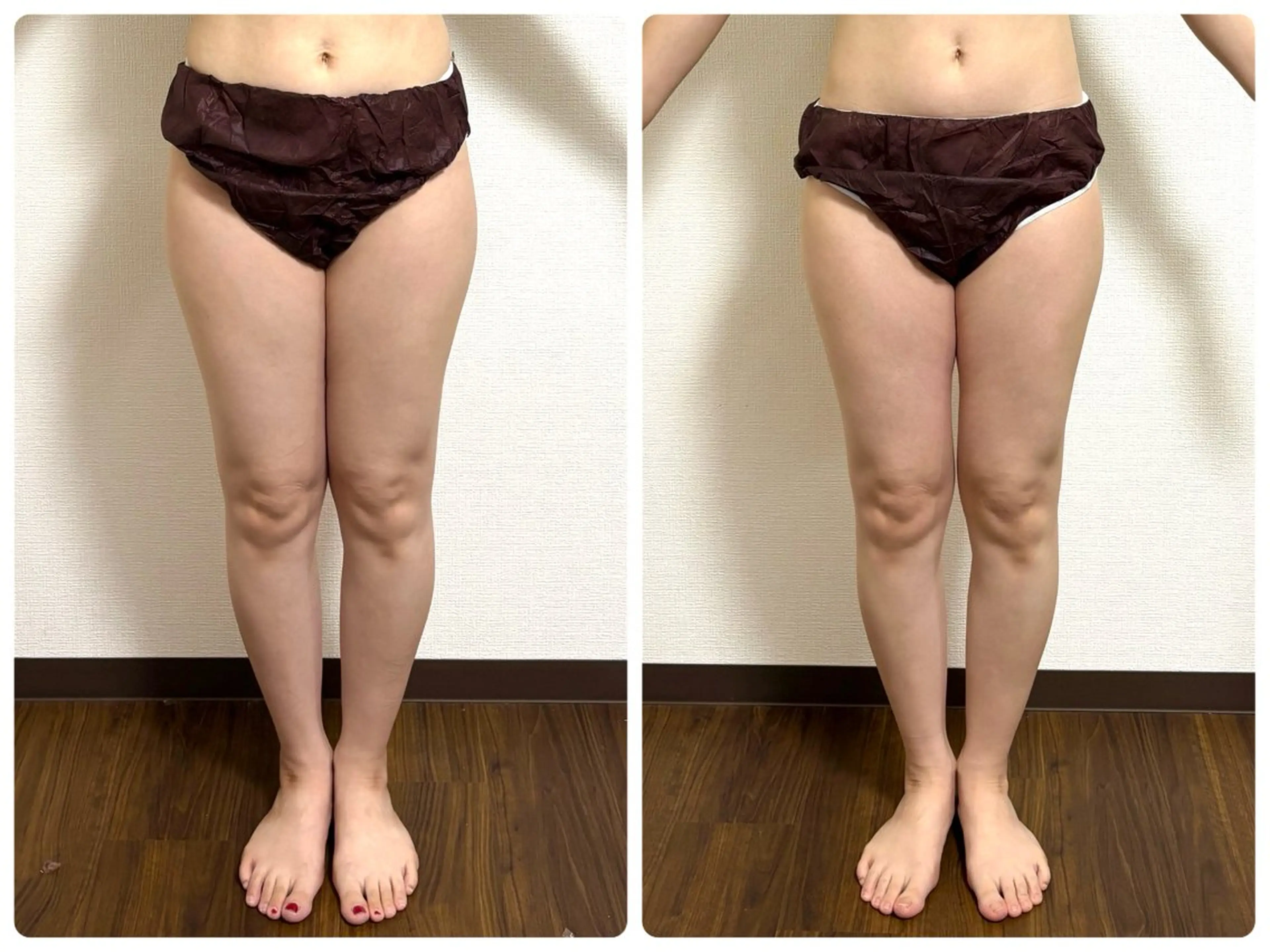 エステ リラク 小顔ハーブピーリング 美容鍼/毛穴洗浄のエステ・リラクイメージ