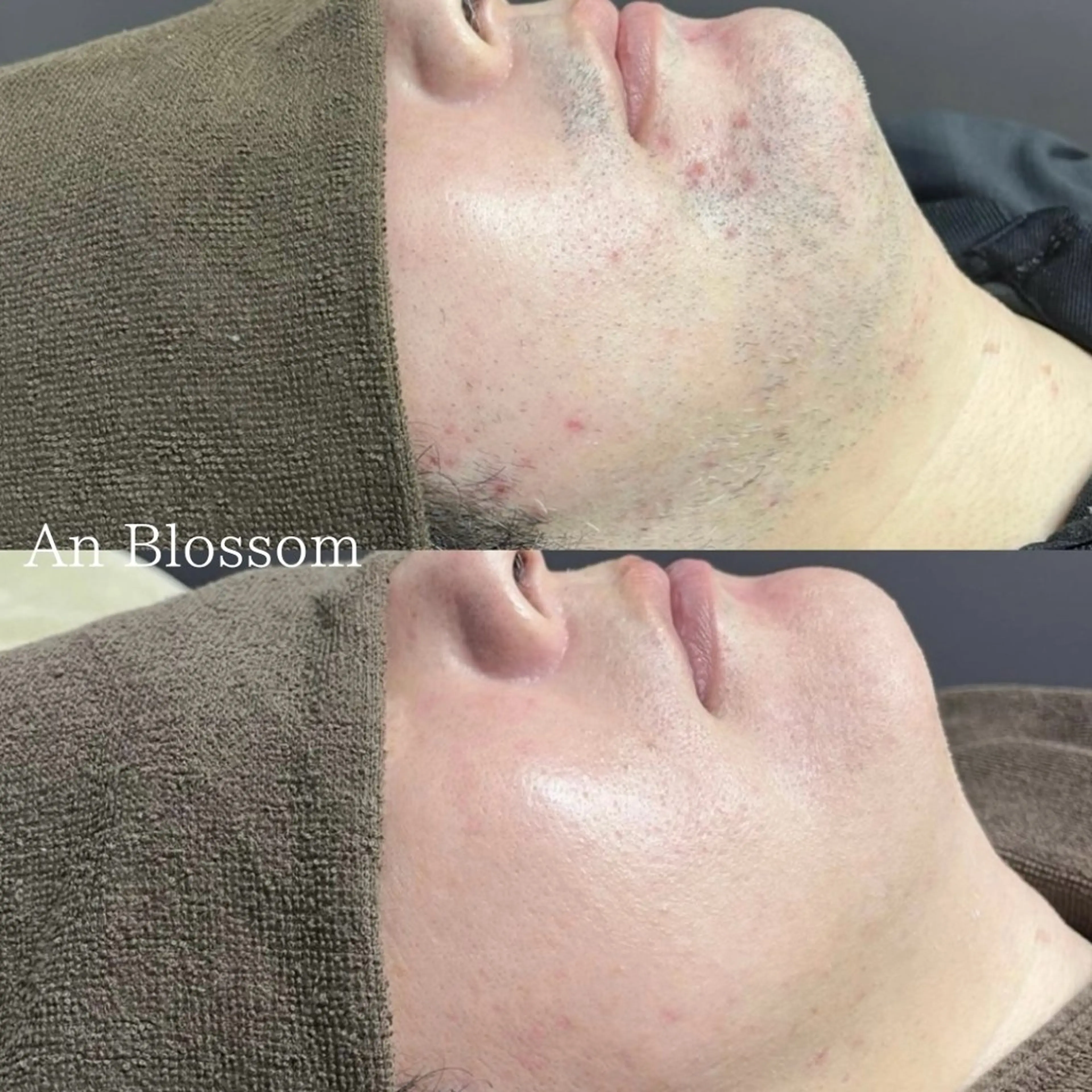 メンズ ビジネス 脱毛 An Blossom 脱毛/茅ヶ崎/美咲のエステ・リラクイメージ