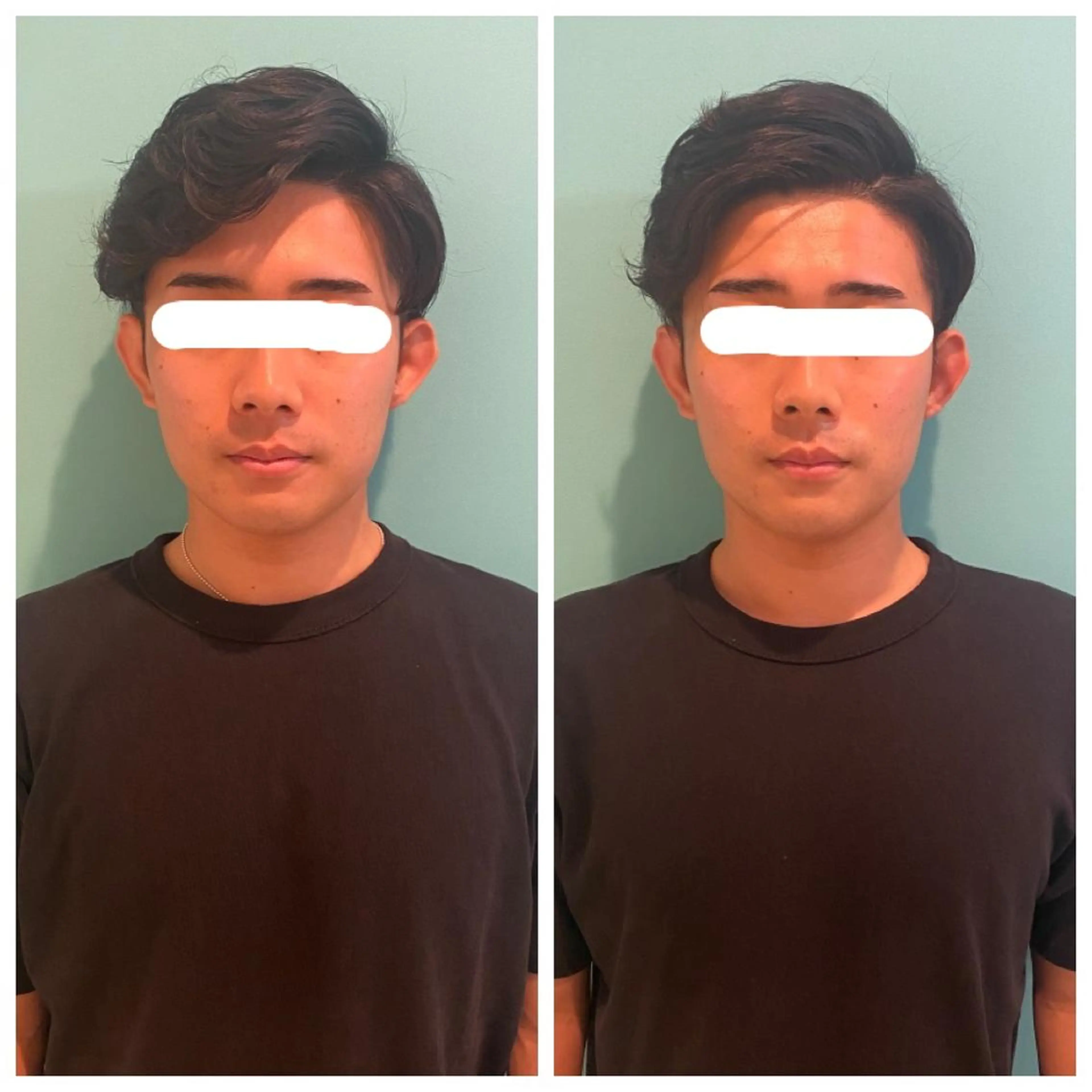 【小顔ケア】小顔EMS+ポレーション導入 ¥5,980‐の写真