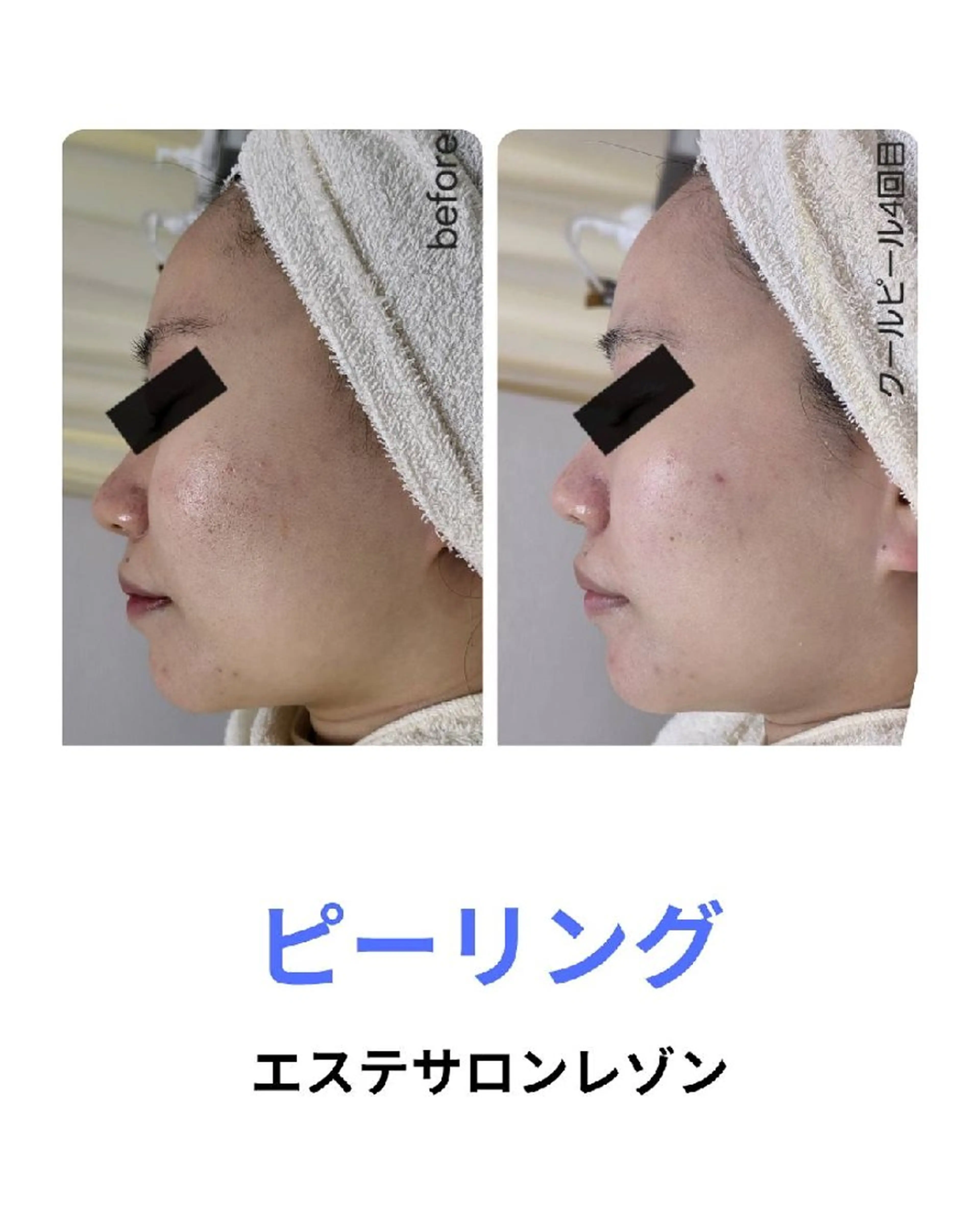 〈ニキビケアサロン〉 レゾン京橋店/ 浅川のエステ・リラクイメージ