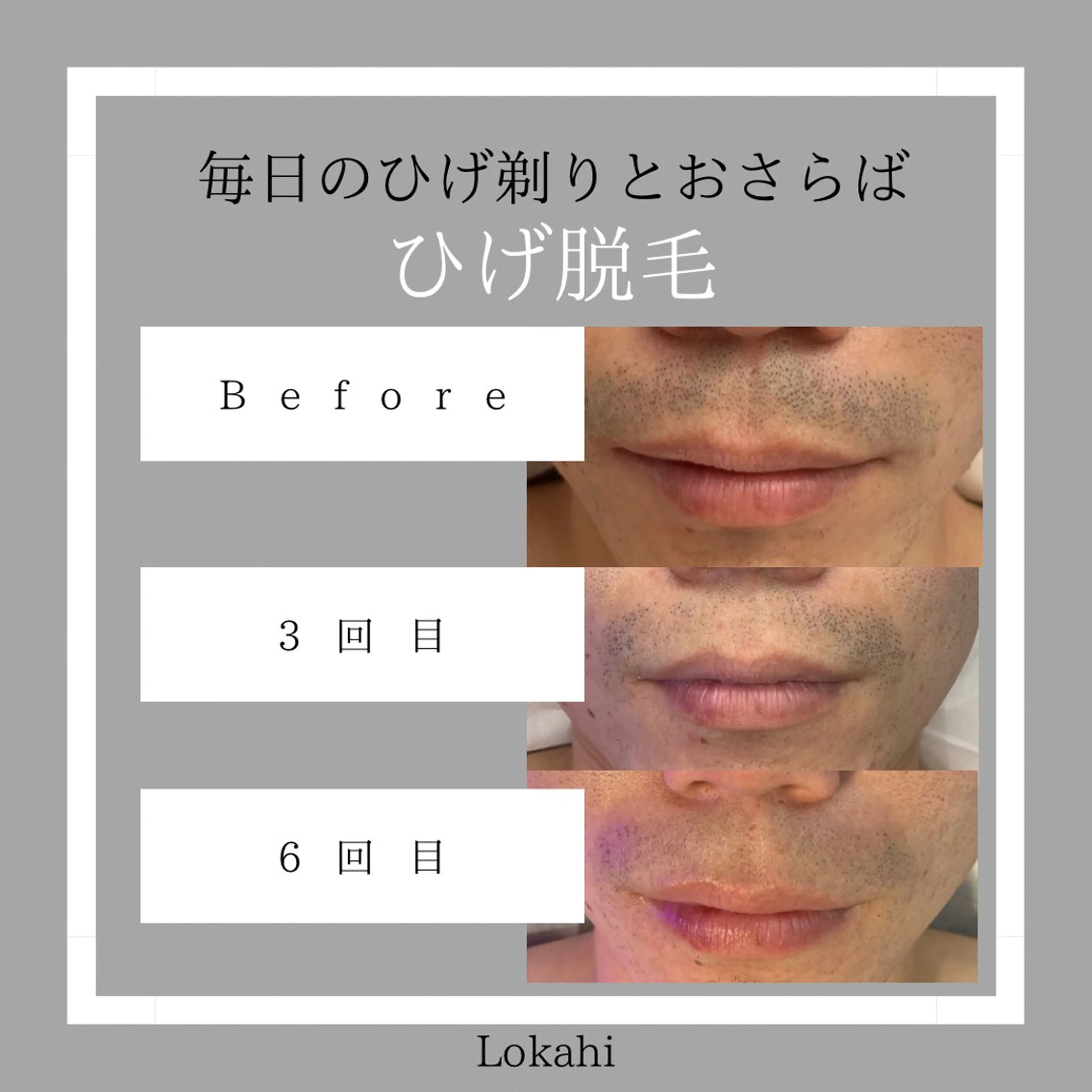 メンズ 全身脱毛／リラク Lokahiのエステ・リラクイメージ