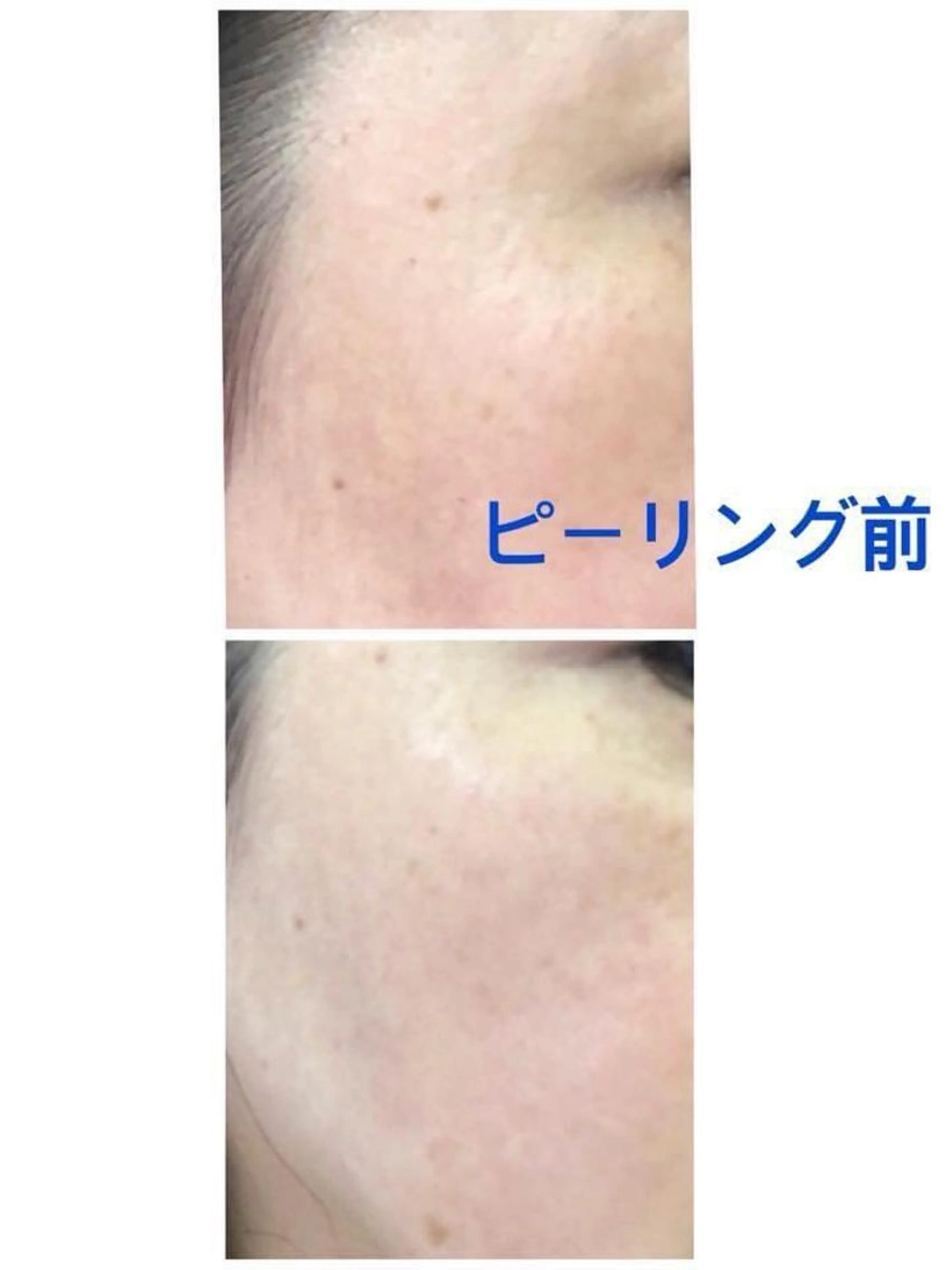 👆毛穴ケアはピーリングです。👆ピーリング+フェイシャルトリートメントの写真