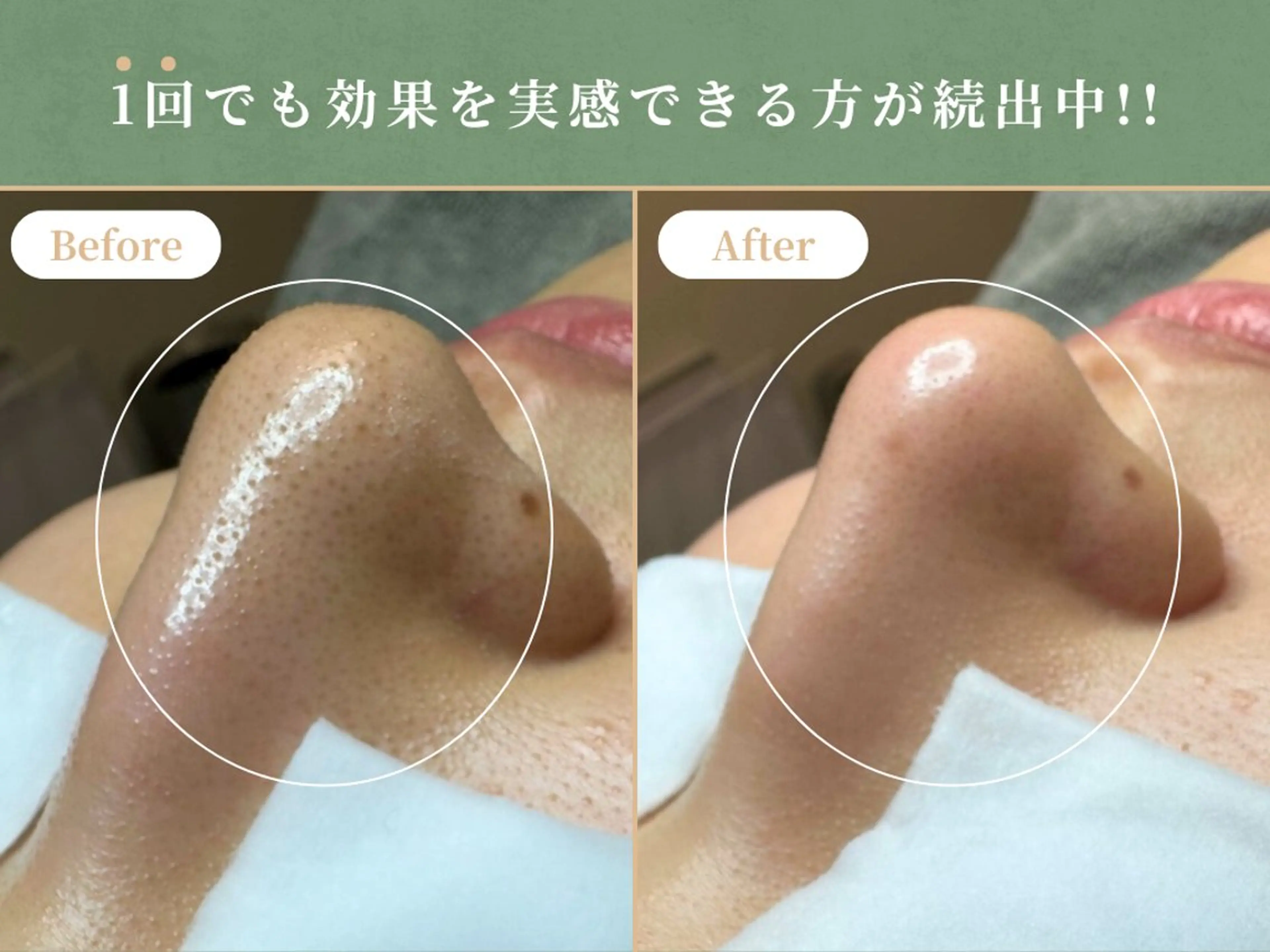 【毛穴ケアプログラム】黒ずみ/凹凸/開きなどのお悩みから解放の写真