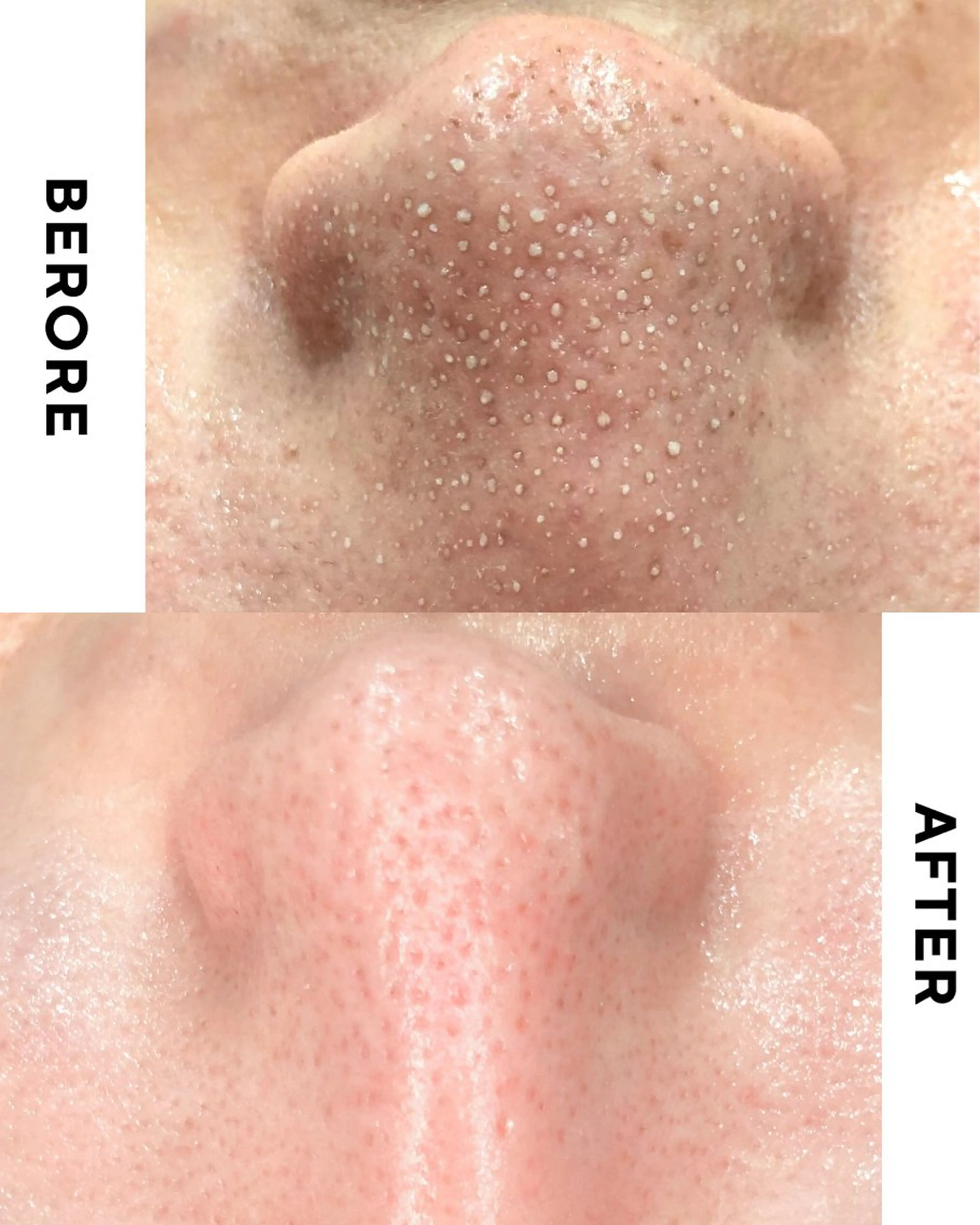 4/13空き◎【新生活応援セール❤️‍🔥】毛穴洗浄6step💎透明つるん肌60分 ◎通常5,500円→3,300円の写真