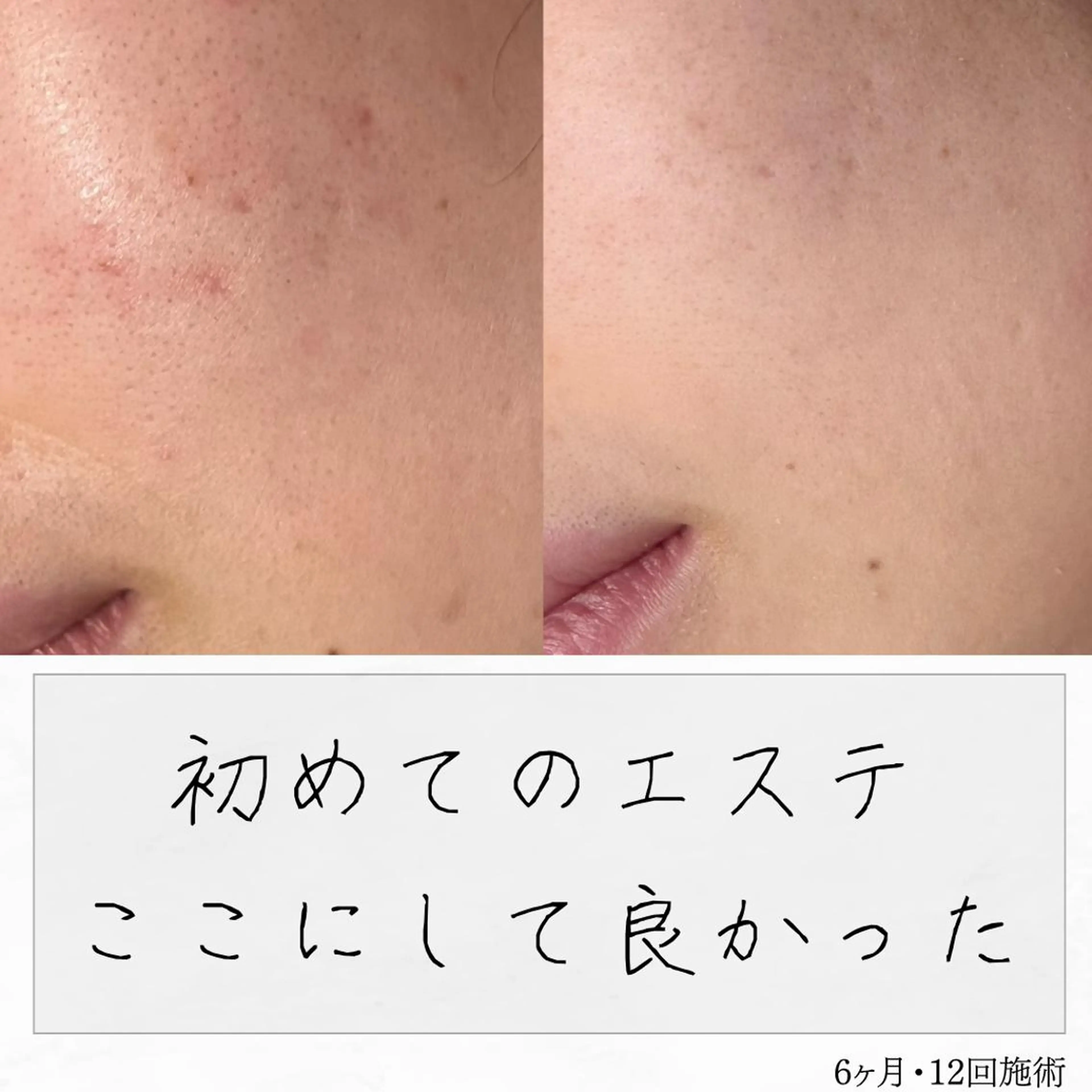 ニキビ経験者が施術 する専門サロン🌻のエステ・リラクイメージ