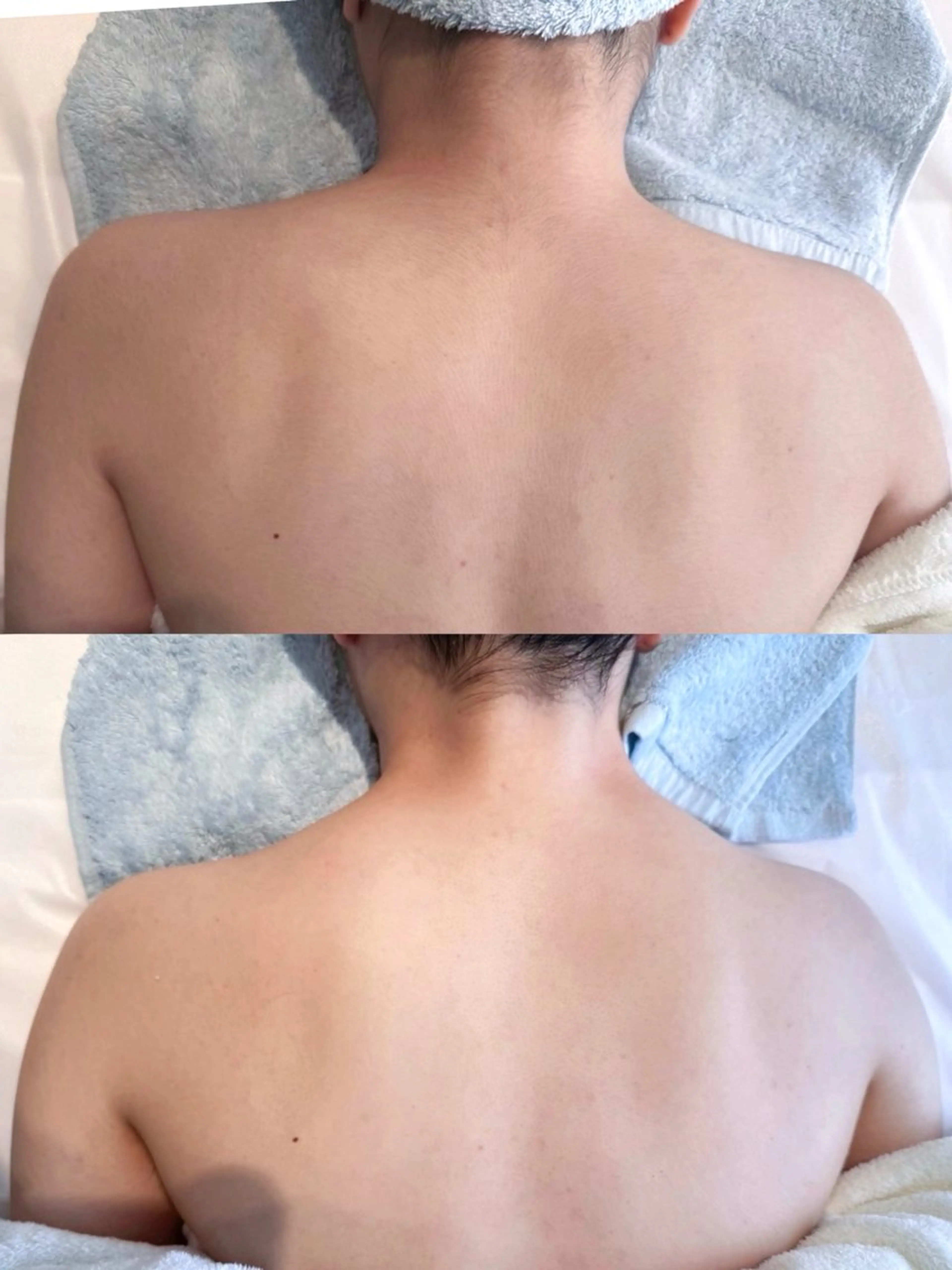 【ウエディング前必見】肌育成ハーブピーリング ［背中］ツルと綺麗なお背中に🫧の写真