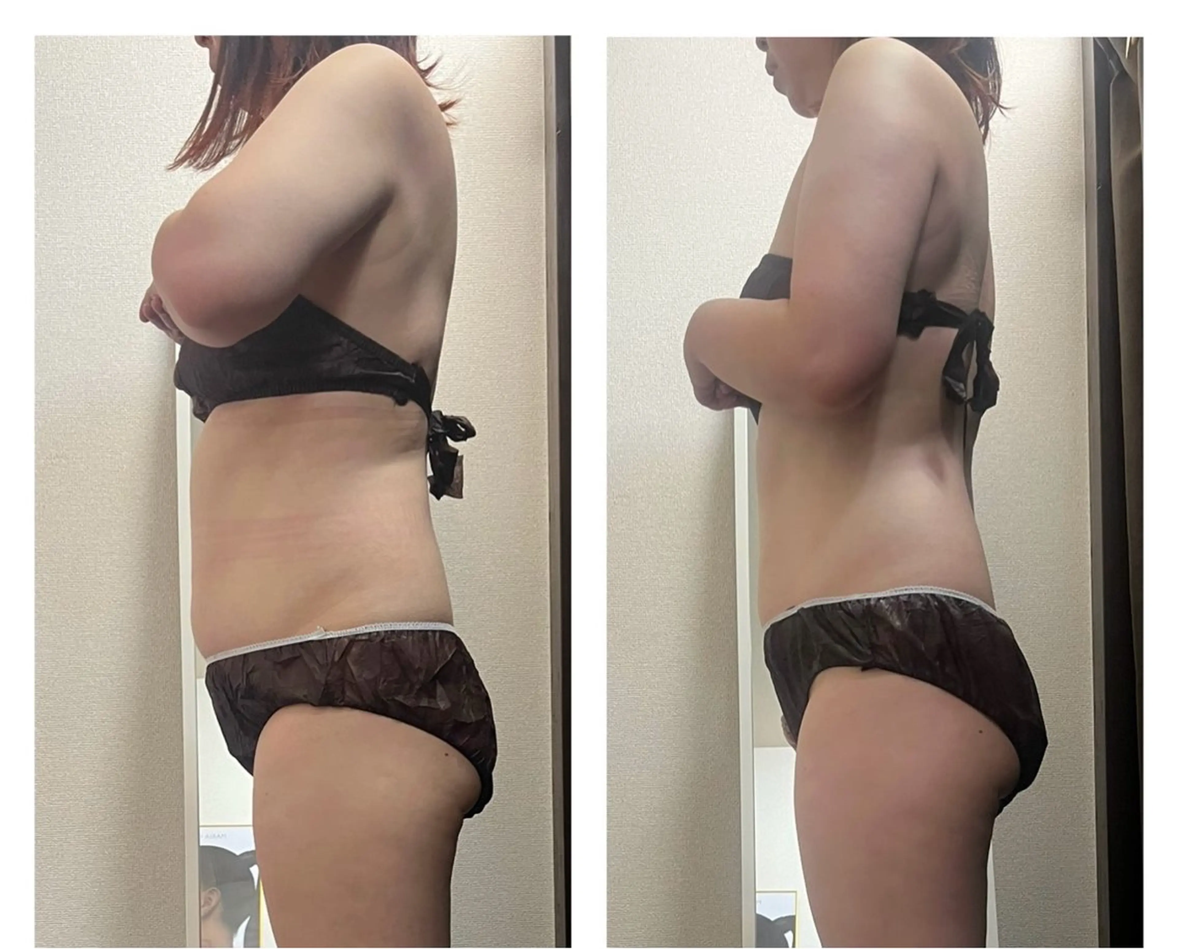 《痩身人気No.1》全身ハイパーナイフ+強力デトックスマッサージ🔥の写真