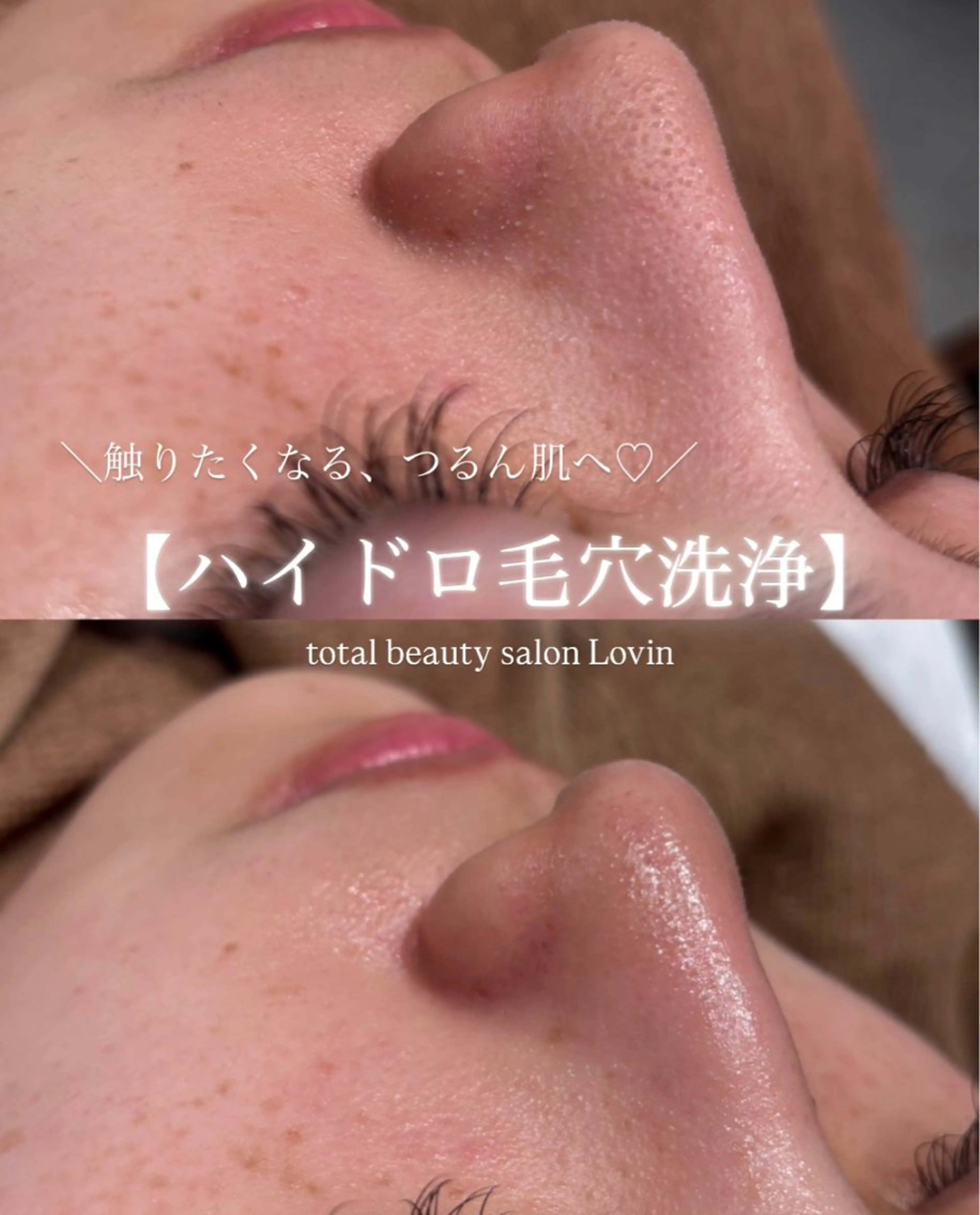 ✨特別クーポン✨【ハイドロ毛穴洗浄】の写真