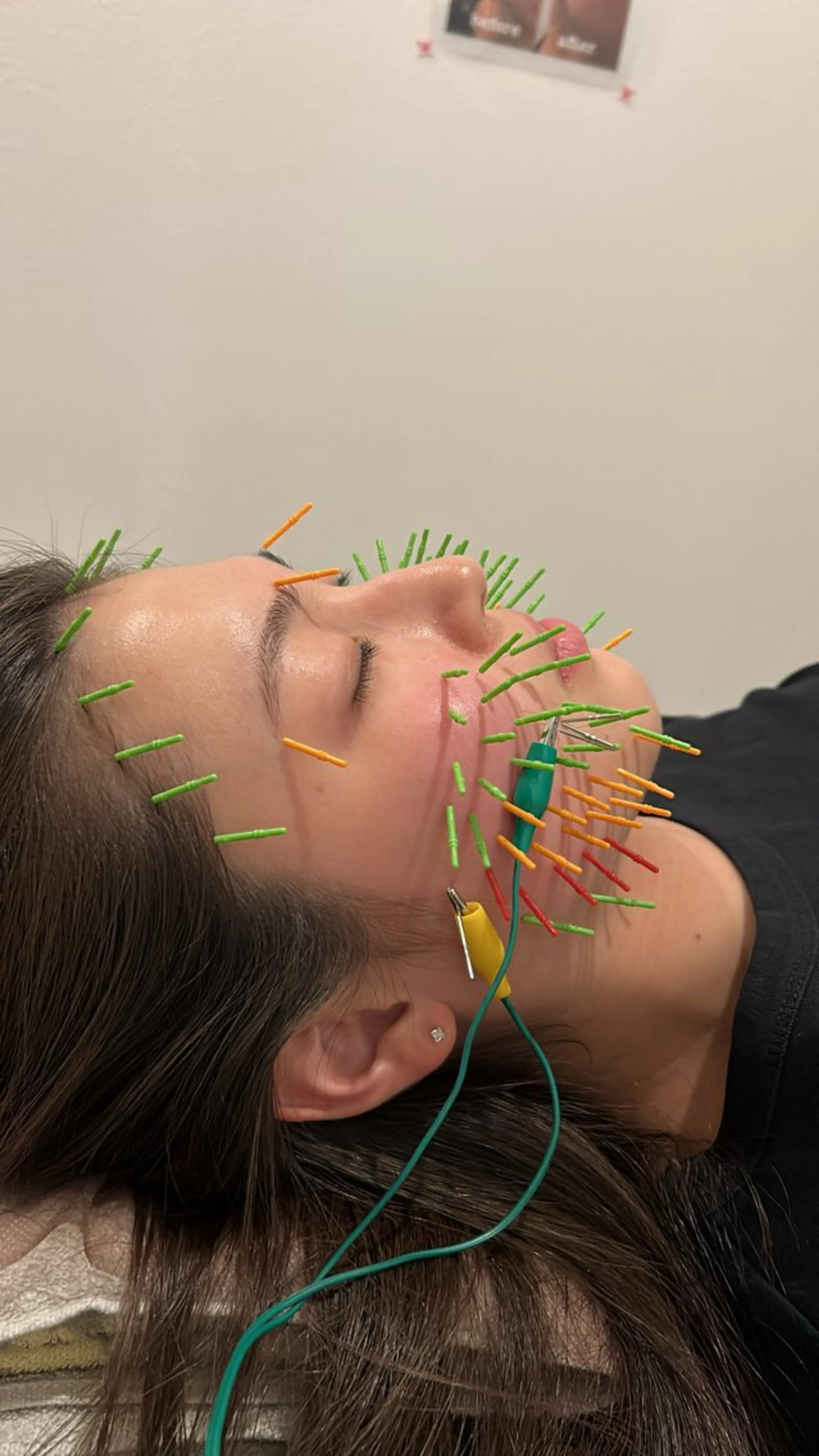 エステ リラク 肌質改善×美容鍼 ゆいのエステ・リラクイメージ