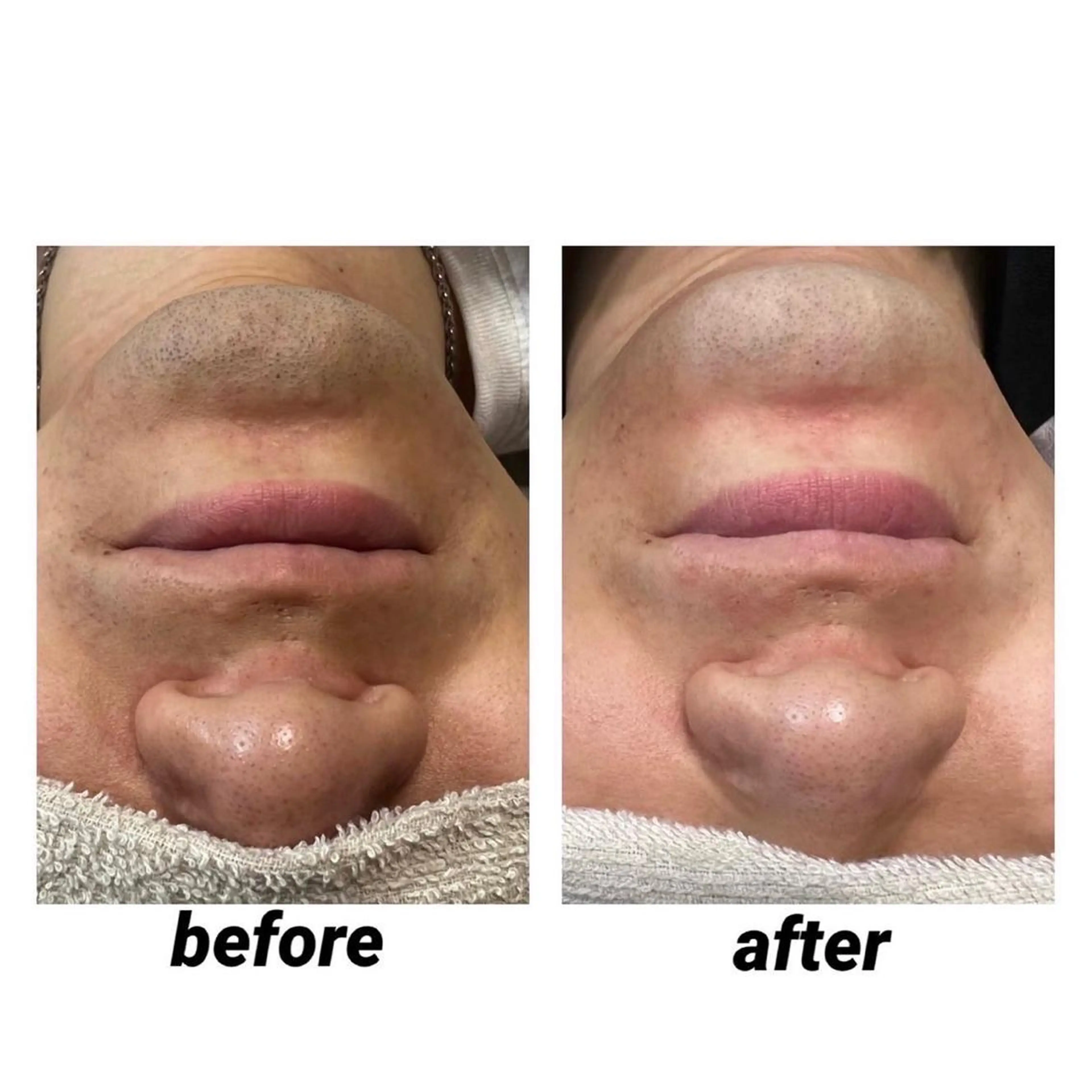 メンズ髭脱毛　5回券の写真