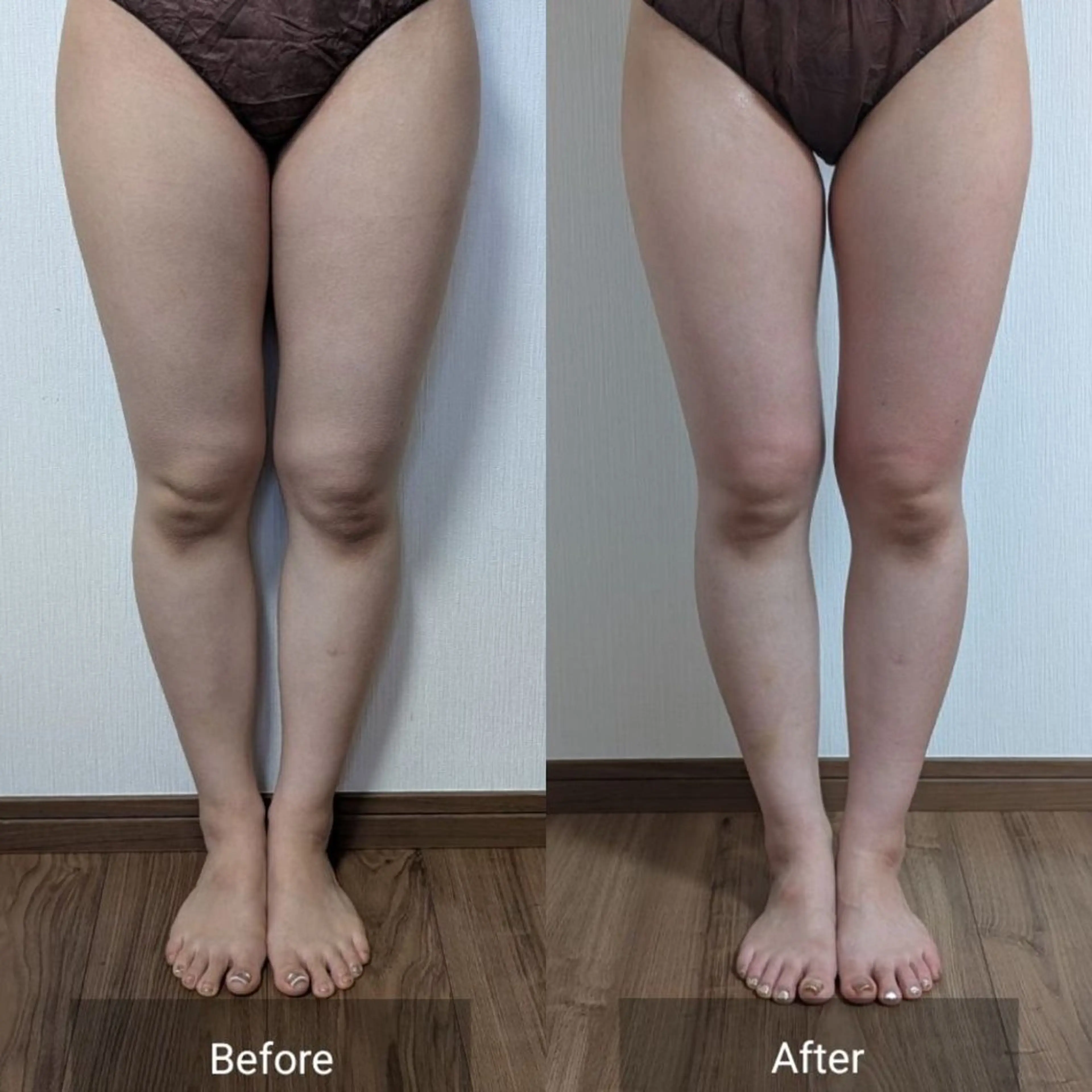 セルライトケア下半身集中コース60分エステの写真