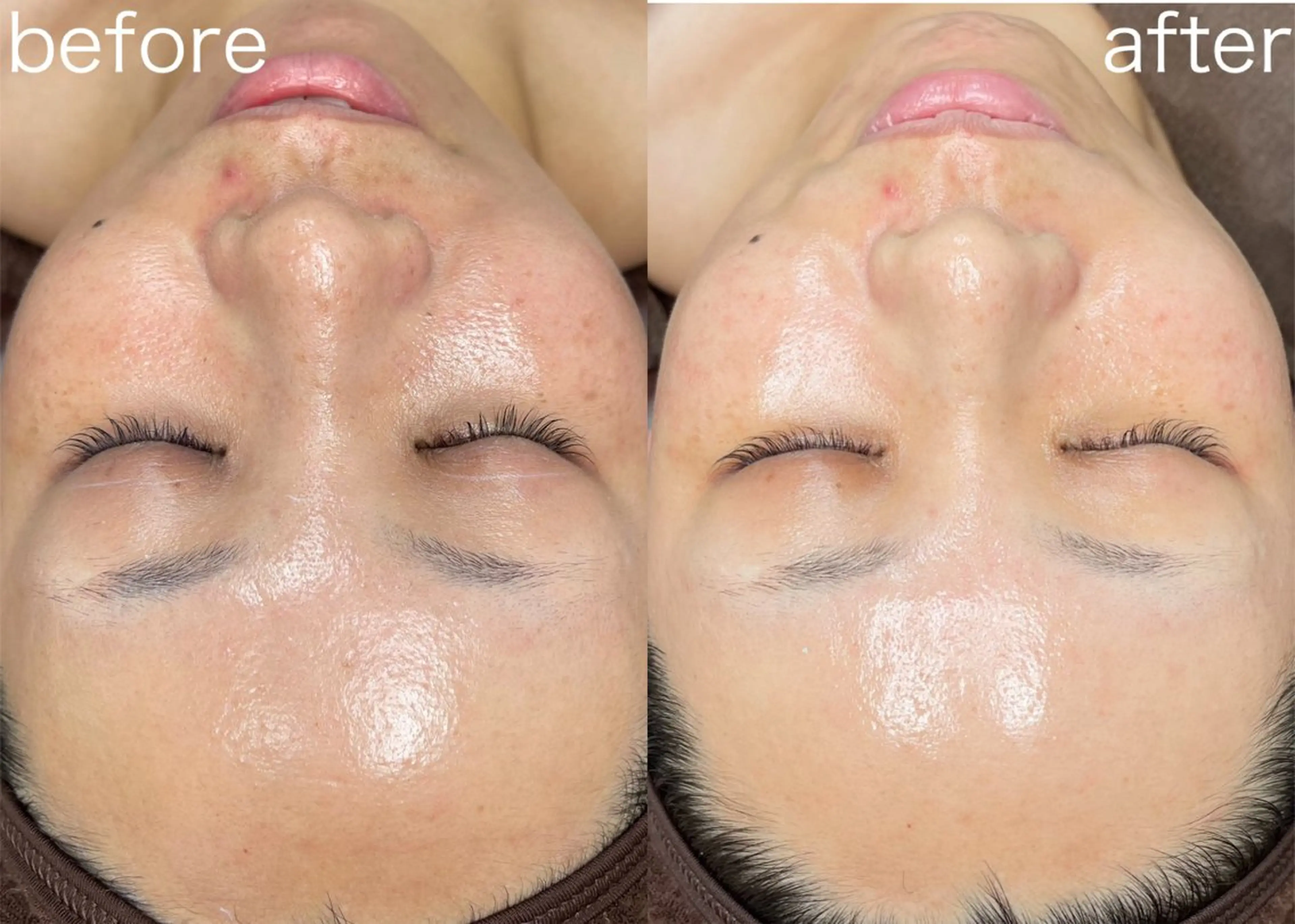 シワ撃退コースの写真