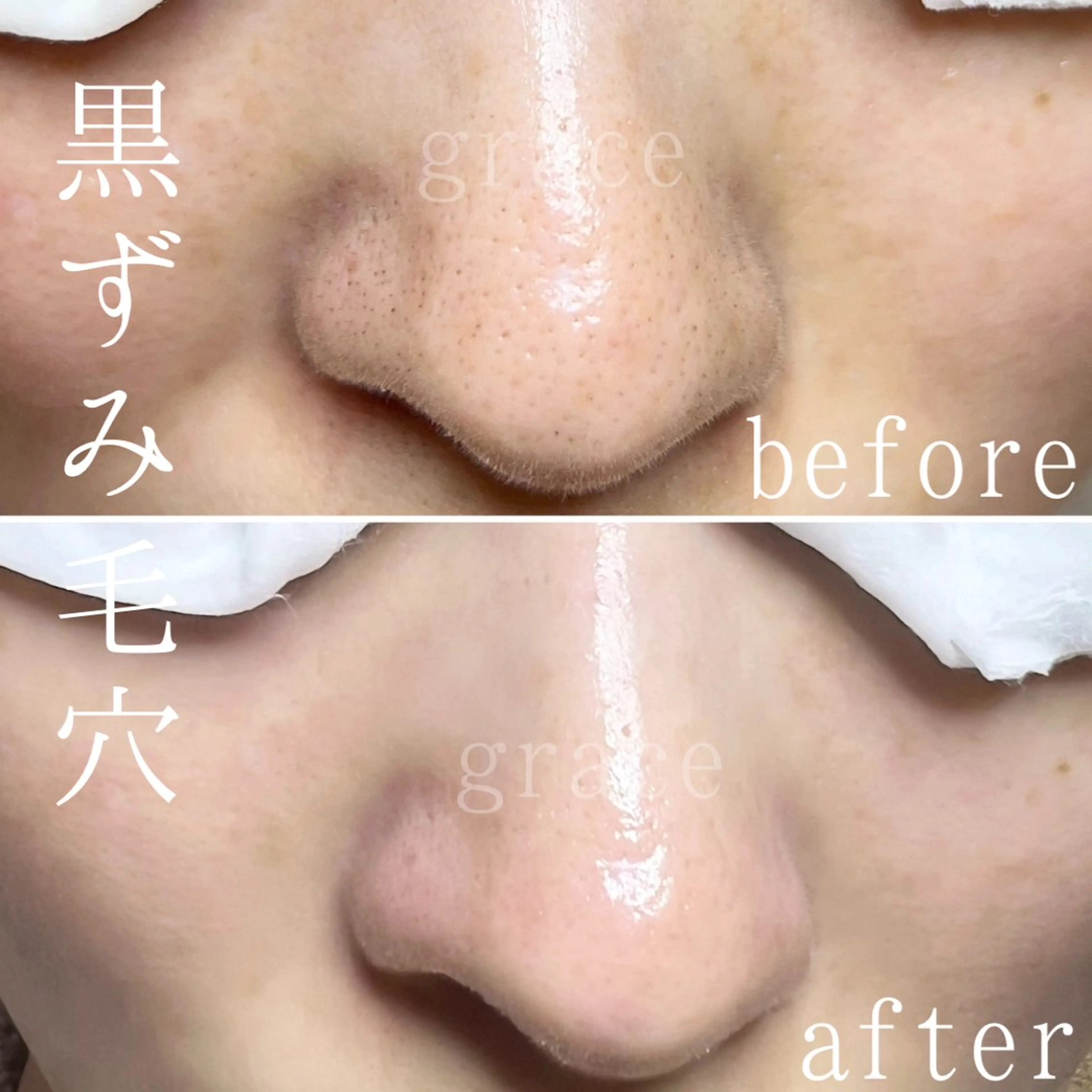 【毛穴改善／１００分】背中・ヘッドスパ付きの写真