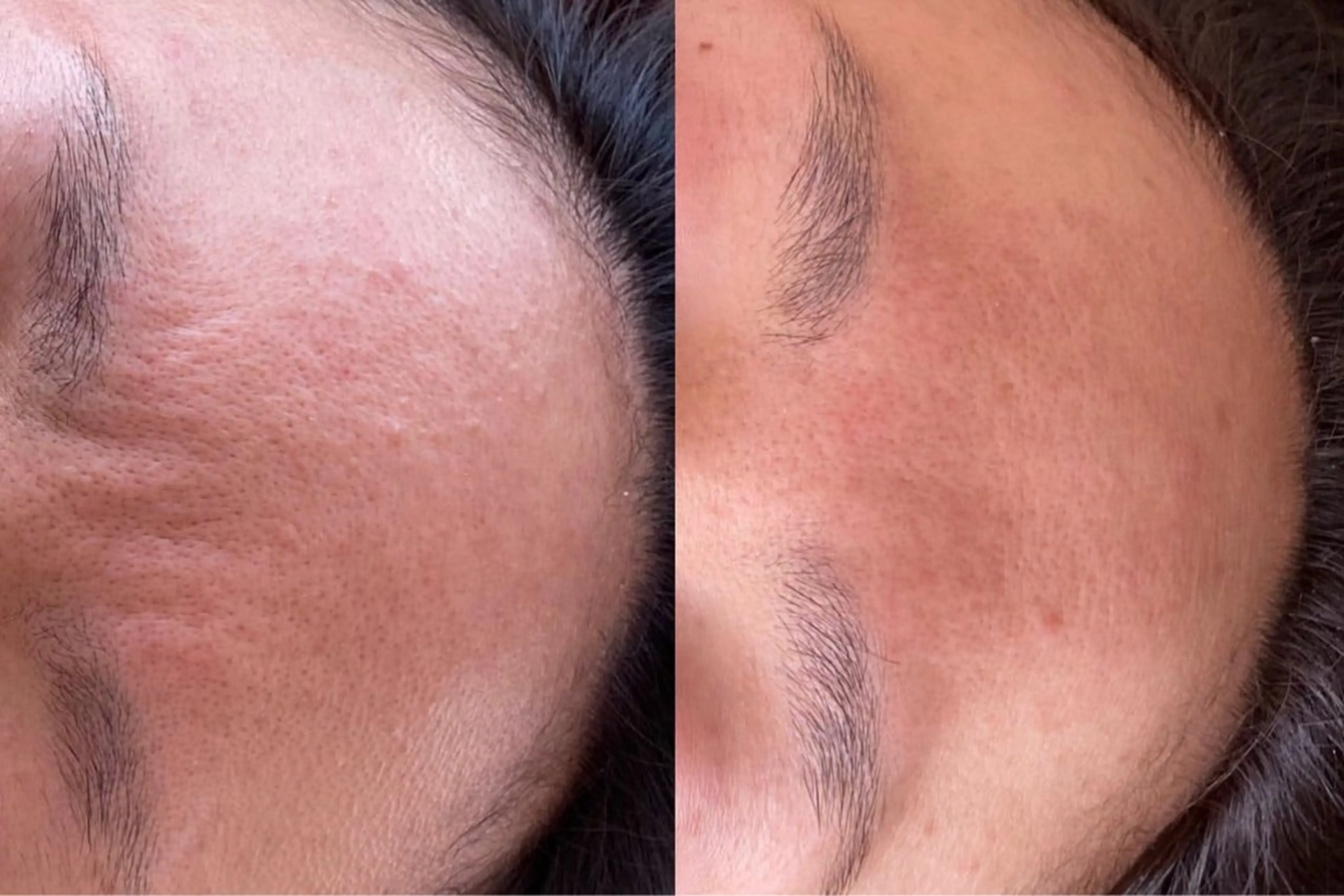 エステ れふぇるん 毛穴洗浄のエステ・リラクイメージ