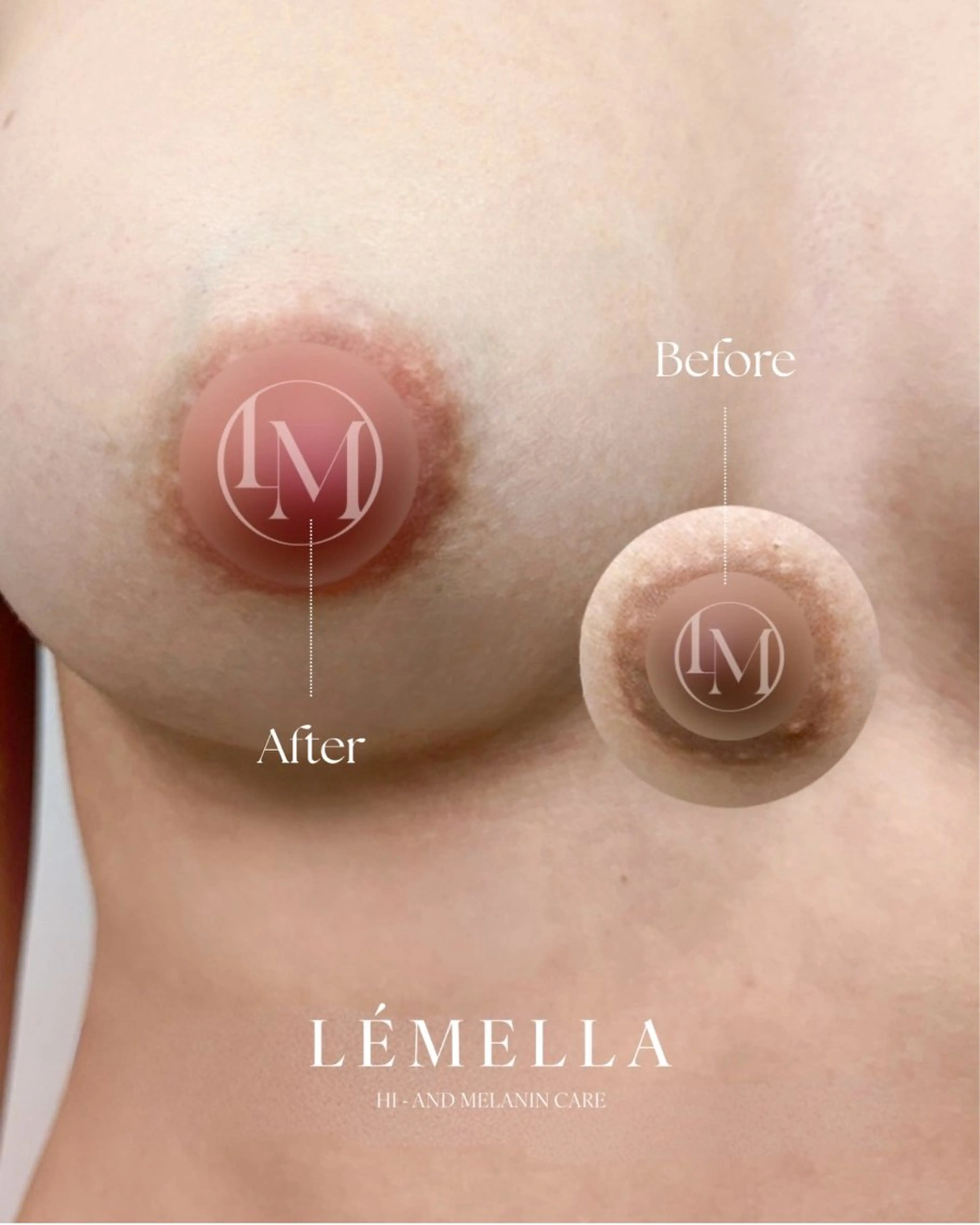 【黒ずみ/メラニンケア】 乳輪周り/たった1回で長年の黒ずみにアプローチ！の写真