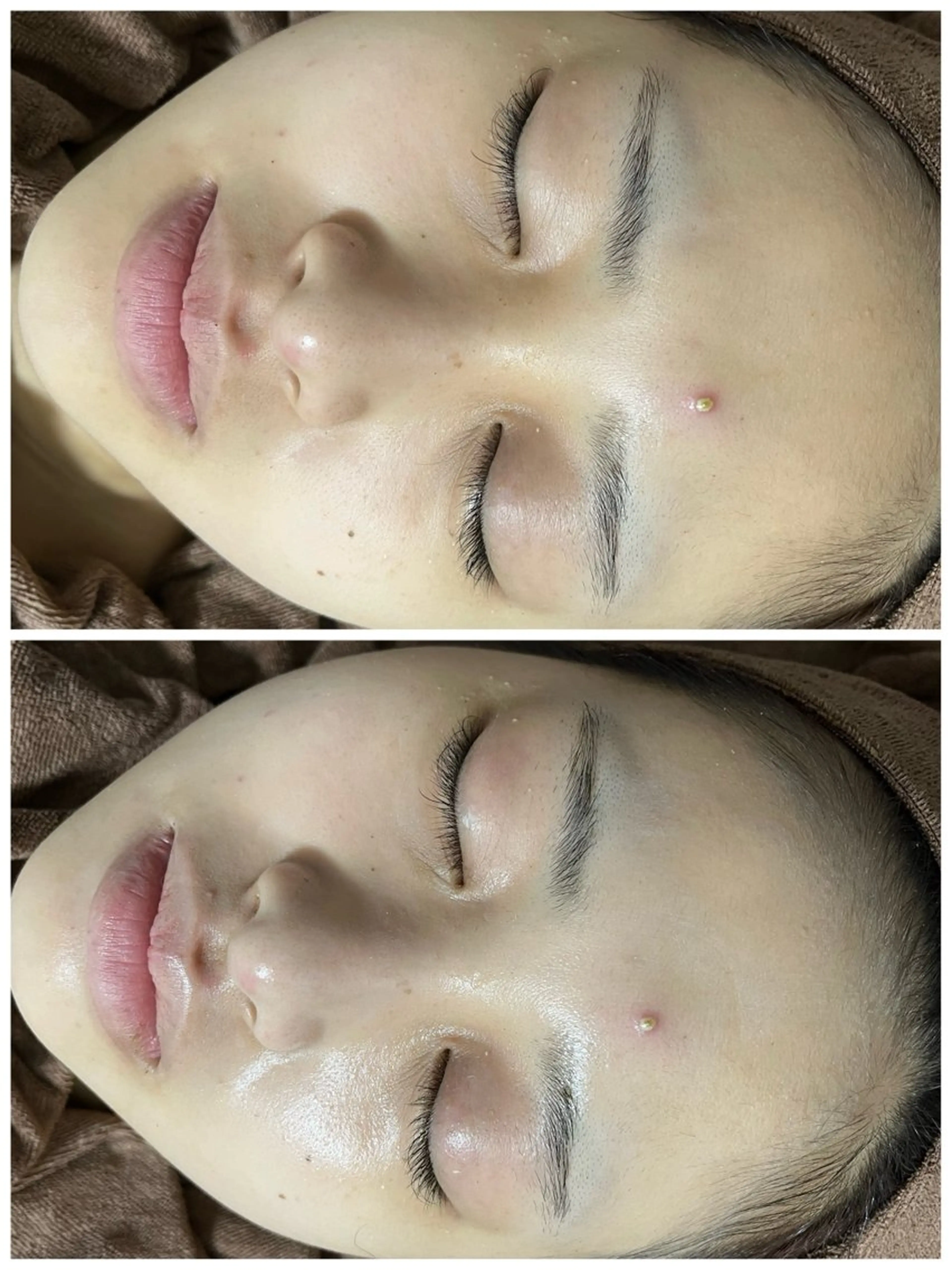 ニキビ／毛穴ケア ハーブピーリングのエステ・リラクイメージ