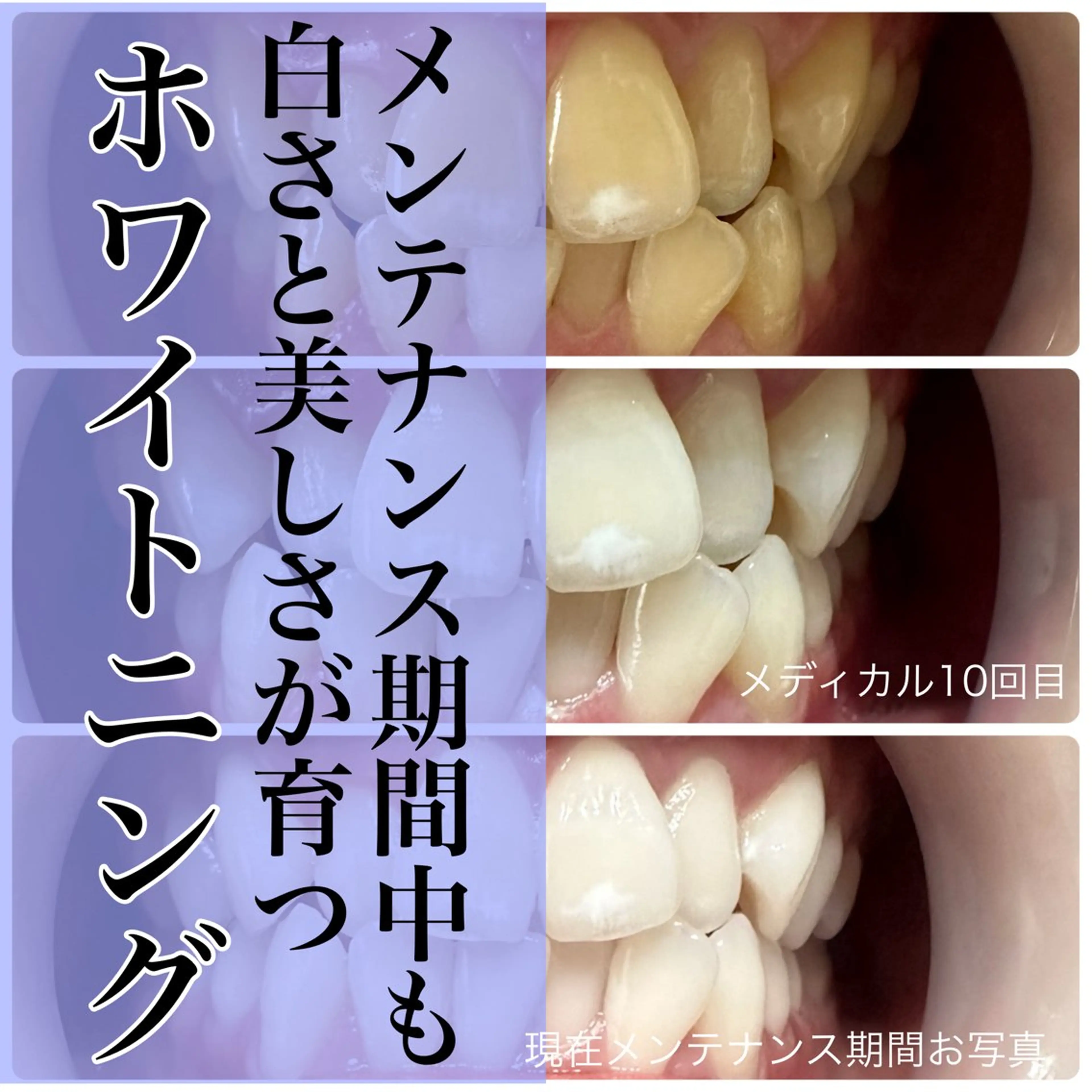 その他 歯のホワイトニング 専門店&whiteのその他イメージ