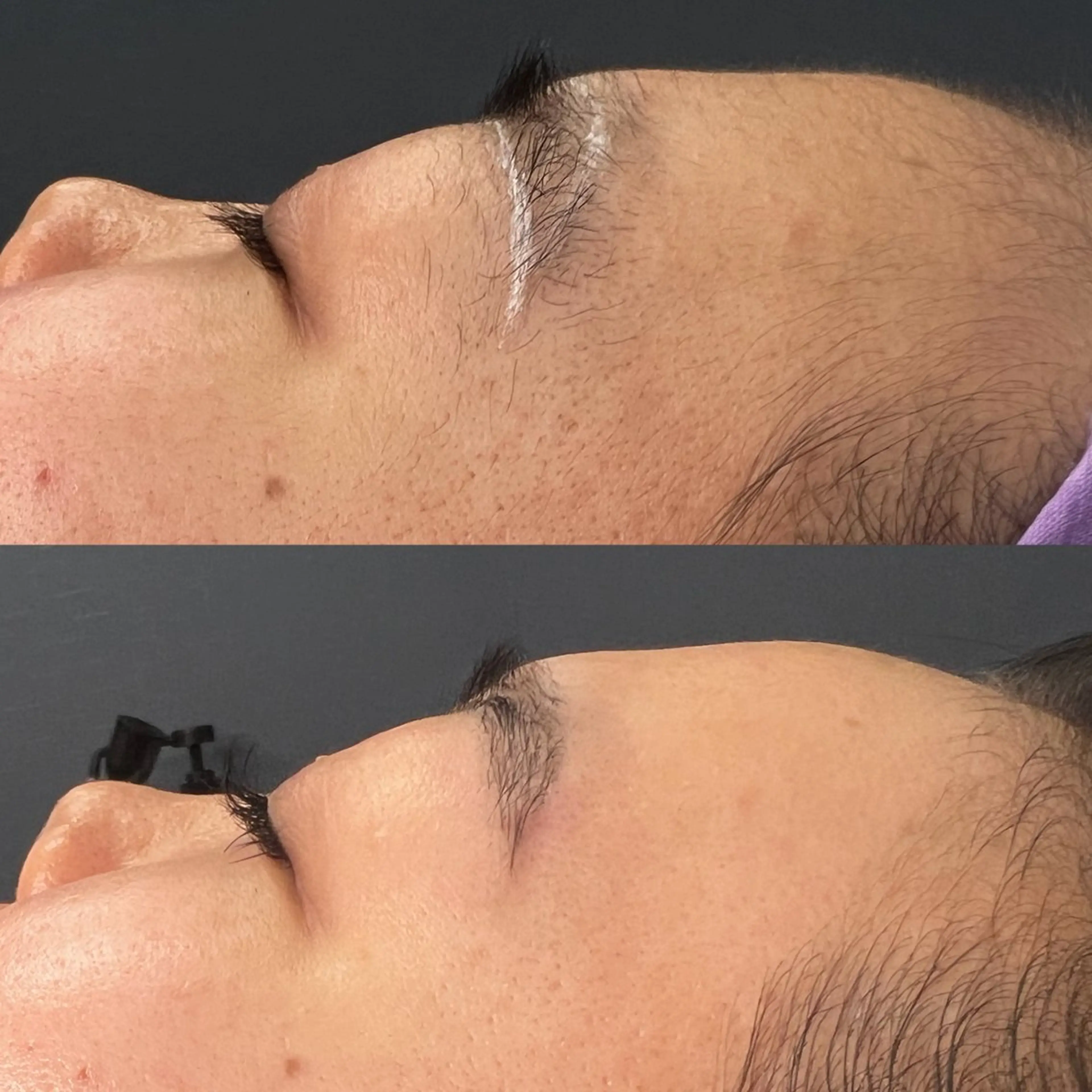 【今話題の❤️‍🔥肌質改善】フェイシャルワックス＆ヒト幹細胞培養液の写真