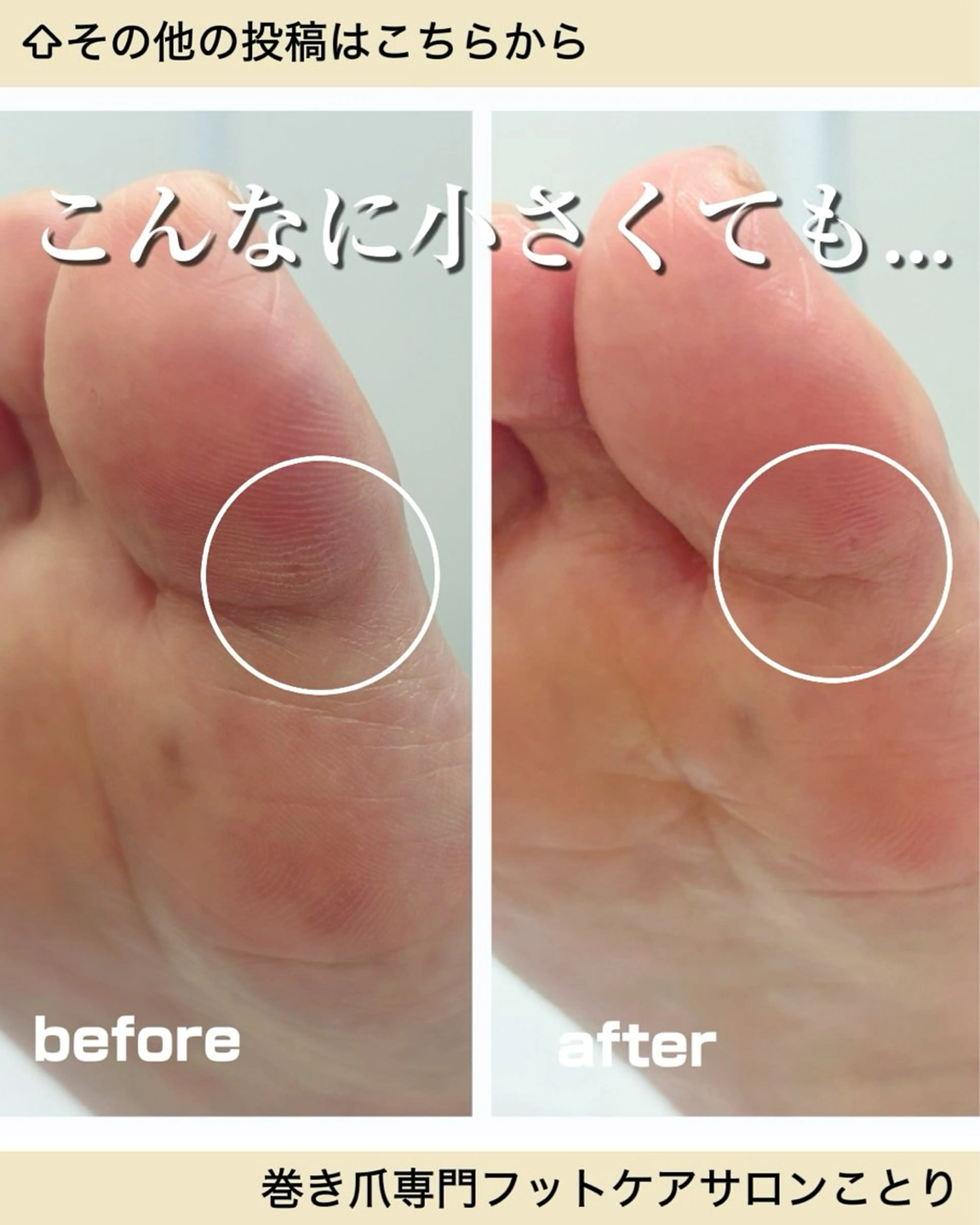 その他 巻き爪フットケアサロンKotori所属・フットケアサロン Kotoriのその他イメージ