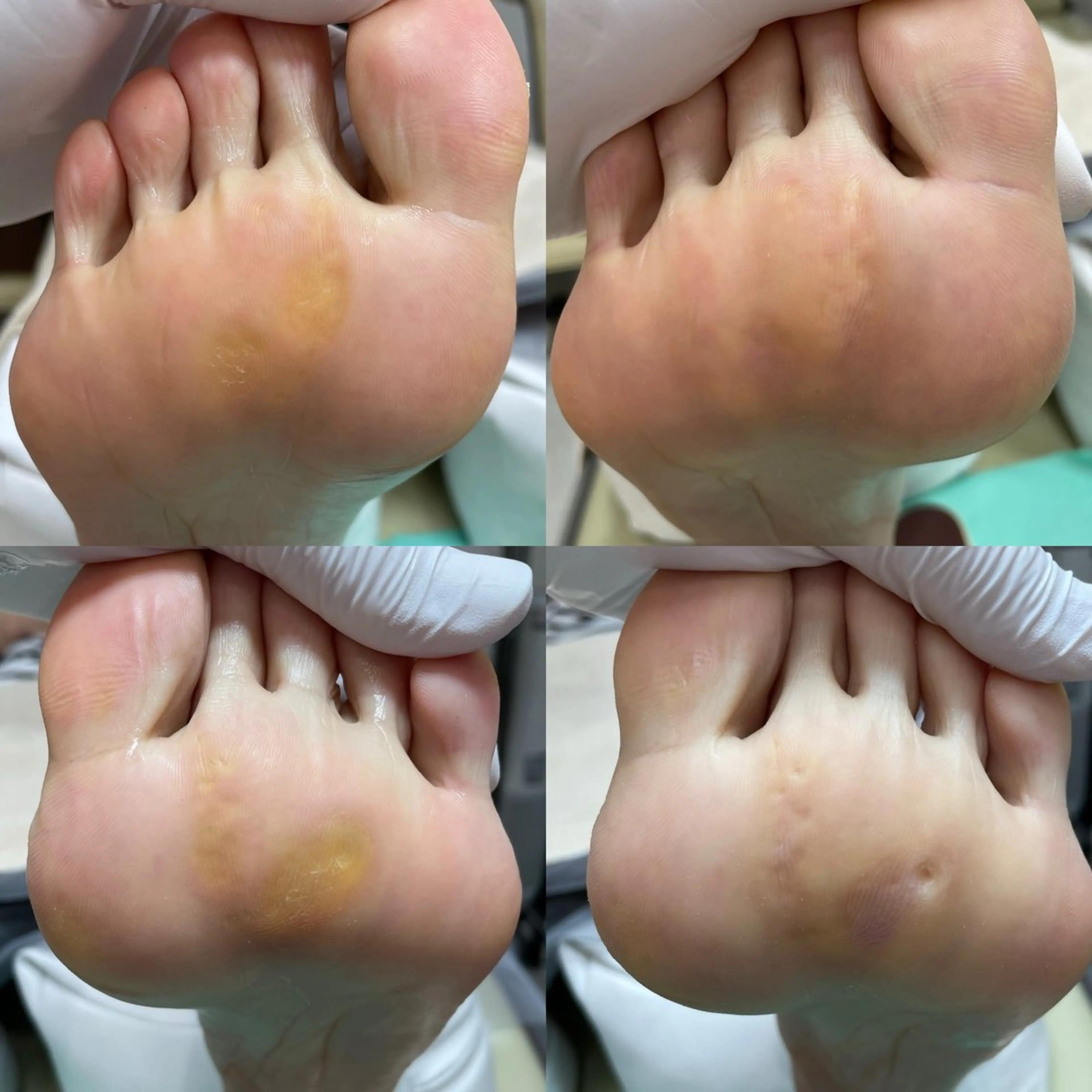 【魚の目ケア】朗報★【得2回目以降もずっと"施術料が500円得】足裏ゴワゴワつらーい魚の目をキレイな足裏へ！の写真