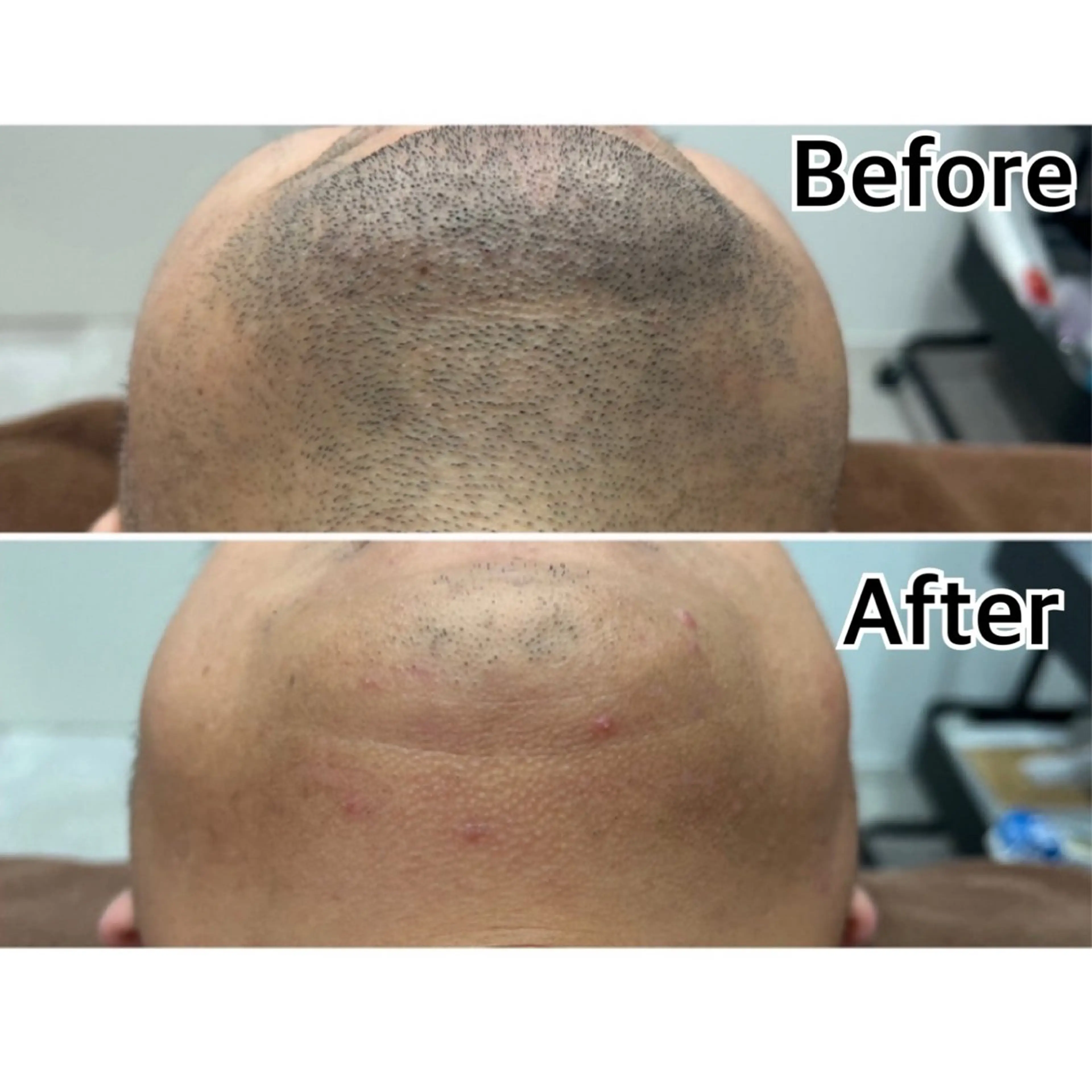 メンズ 脱毛 林 陽向のエステ・リラクイメージ