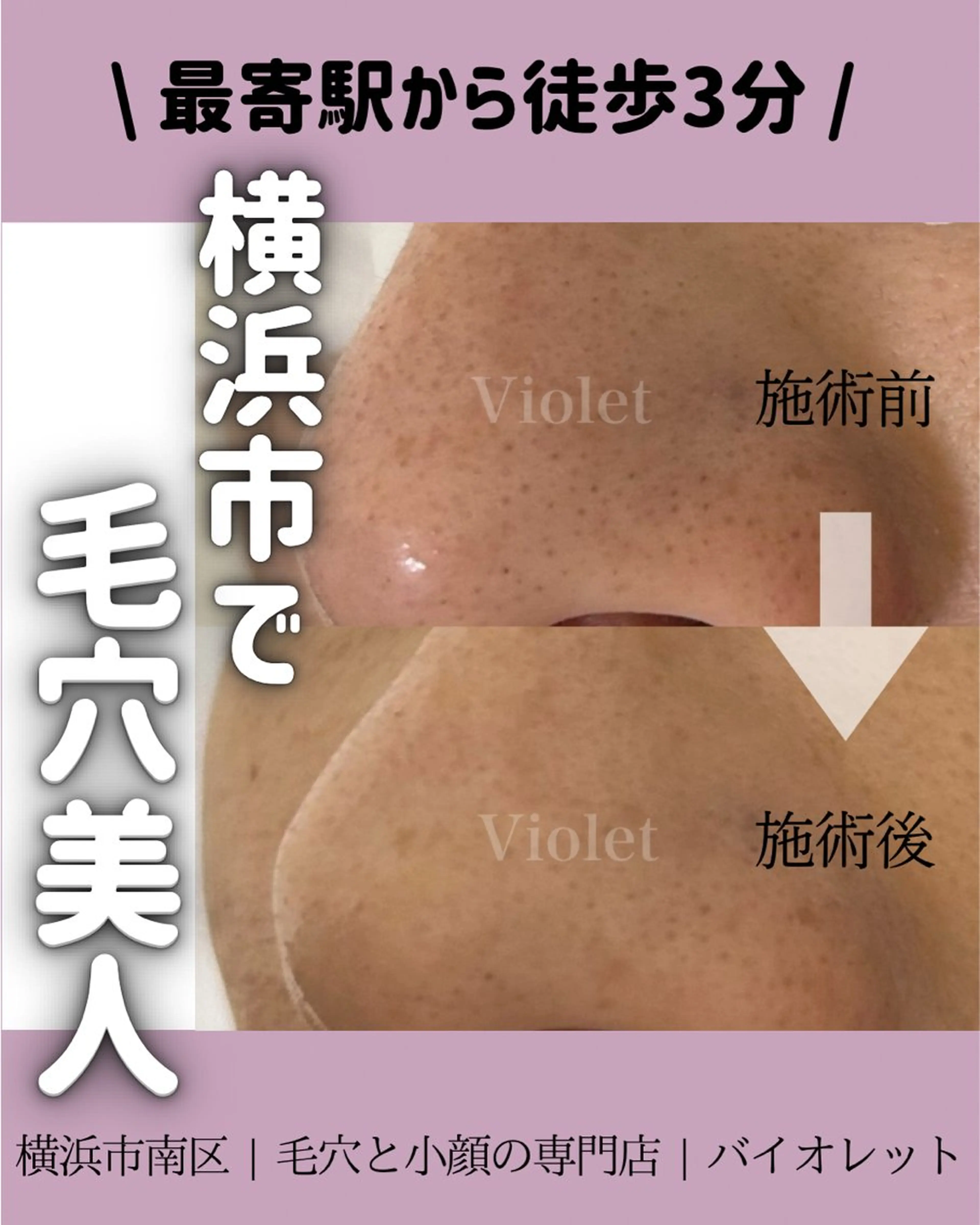 その他 毛穴と耳つぼ専門店 バイオレット　りののその他イメージ