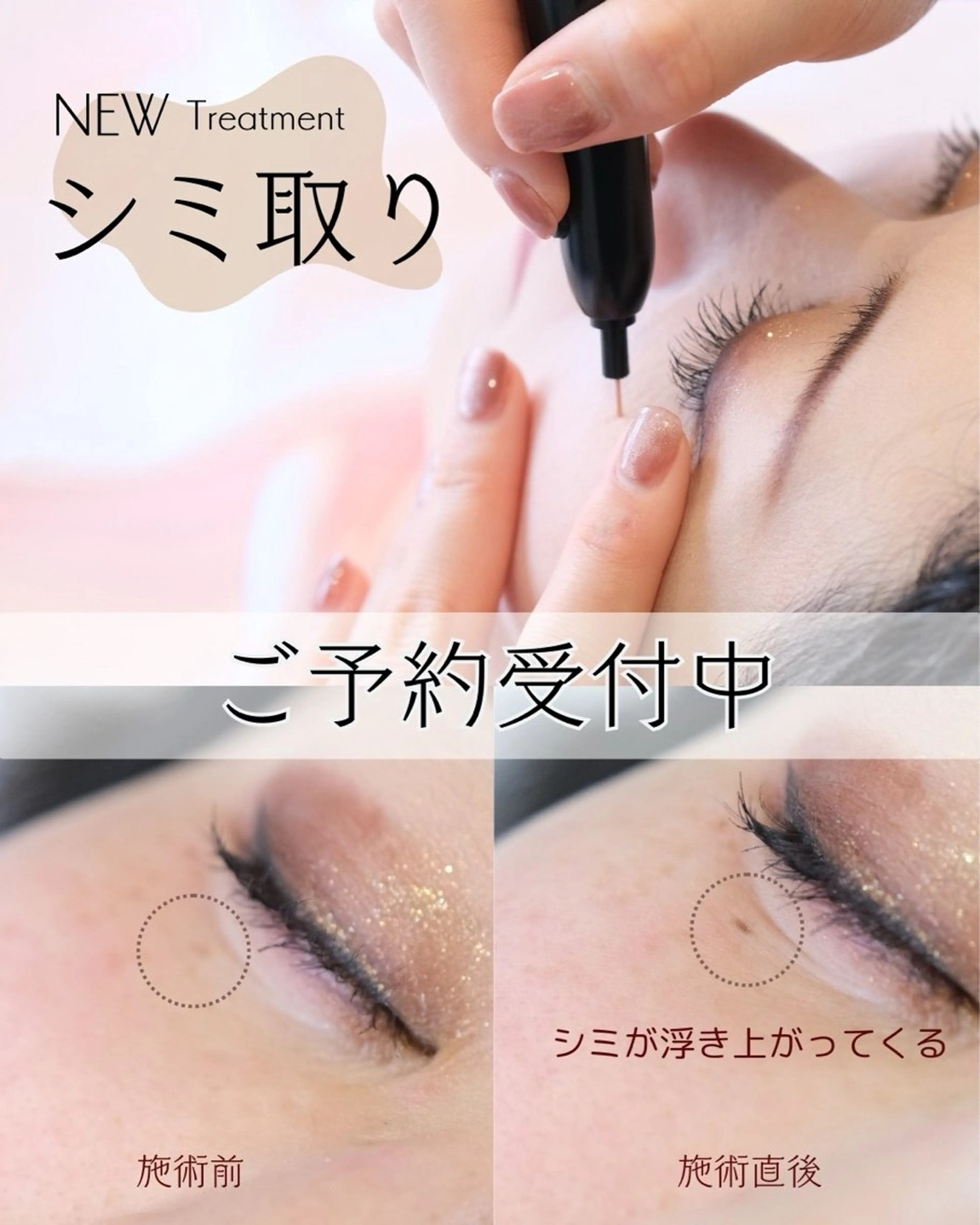 【シミケア】5箇所ピンポイントシミケアの写真