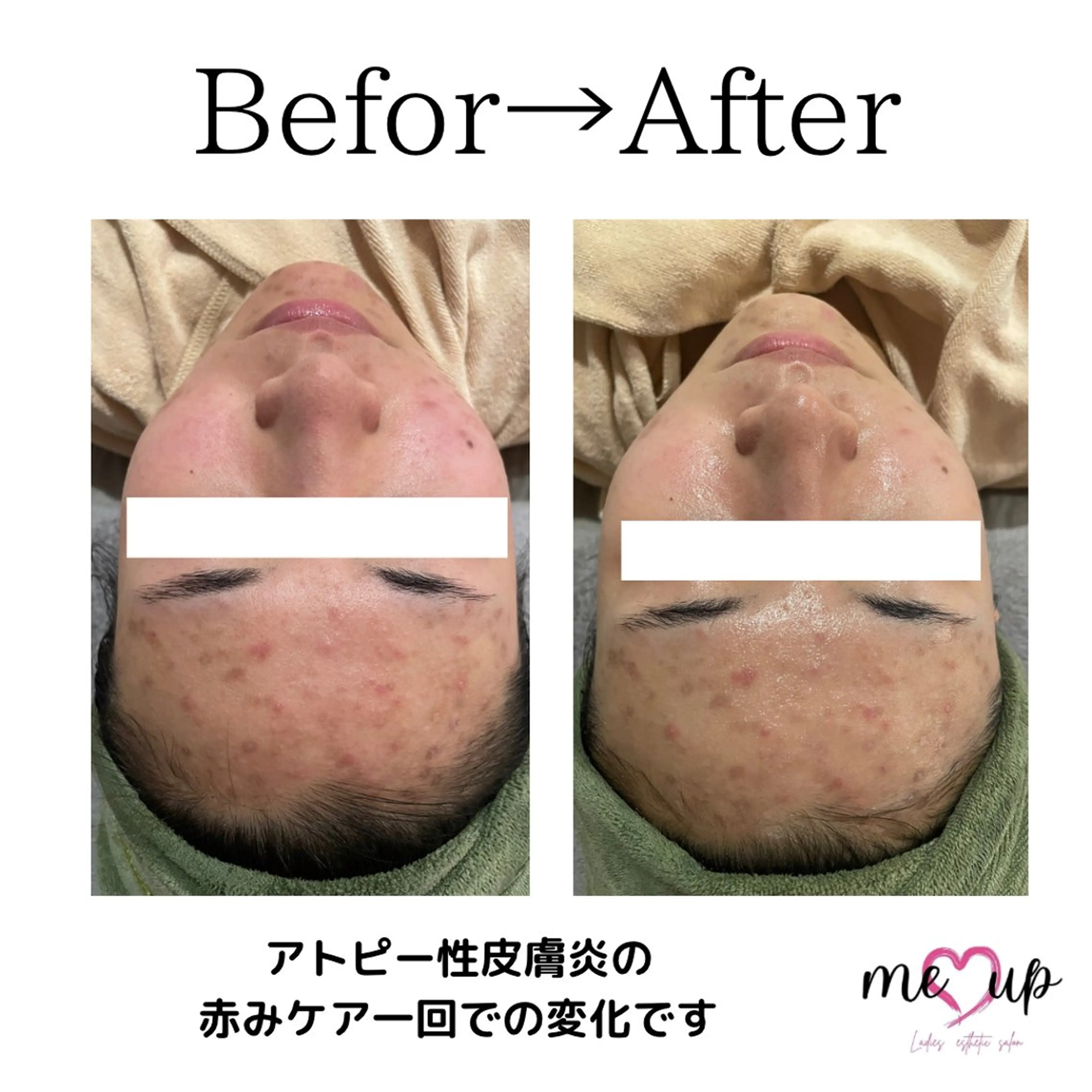 Meupニキビ専門店 背中/ハーブ/肌管理のその他イメージ