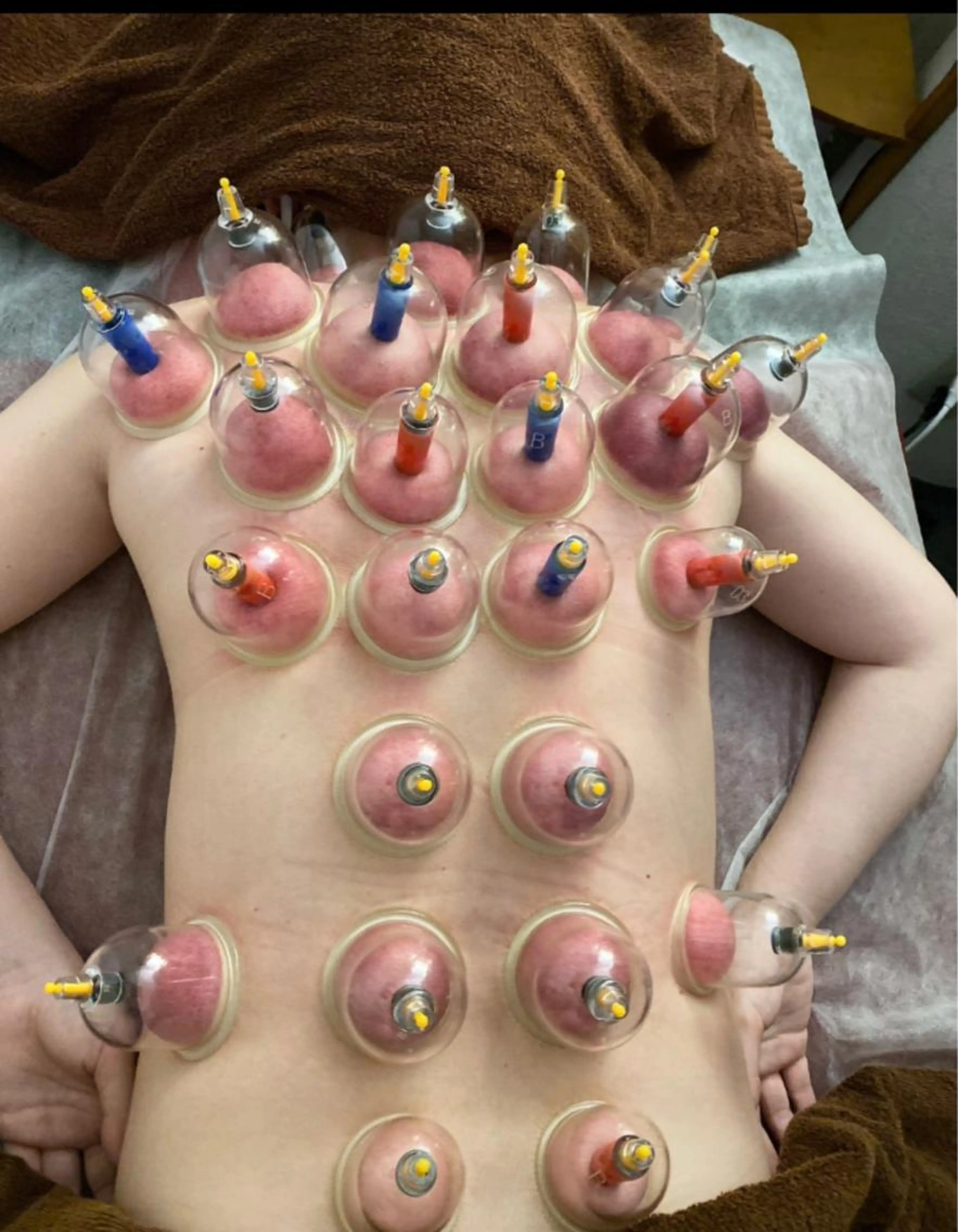 カッピングの写真