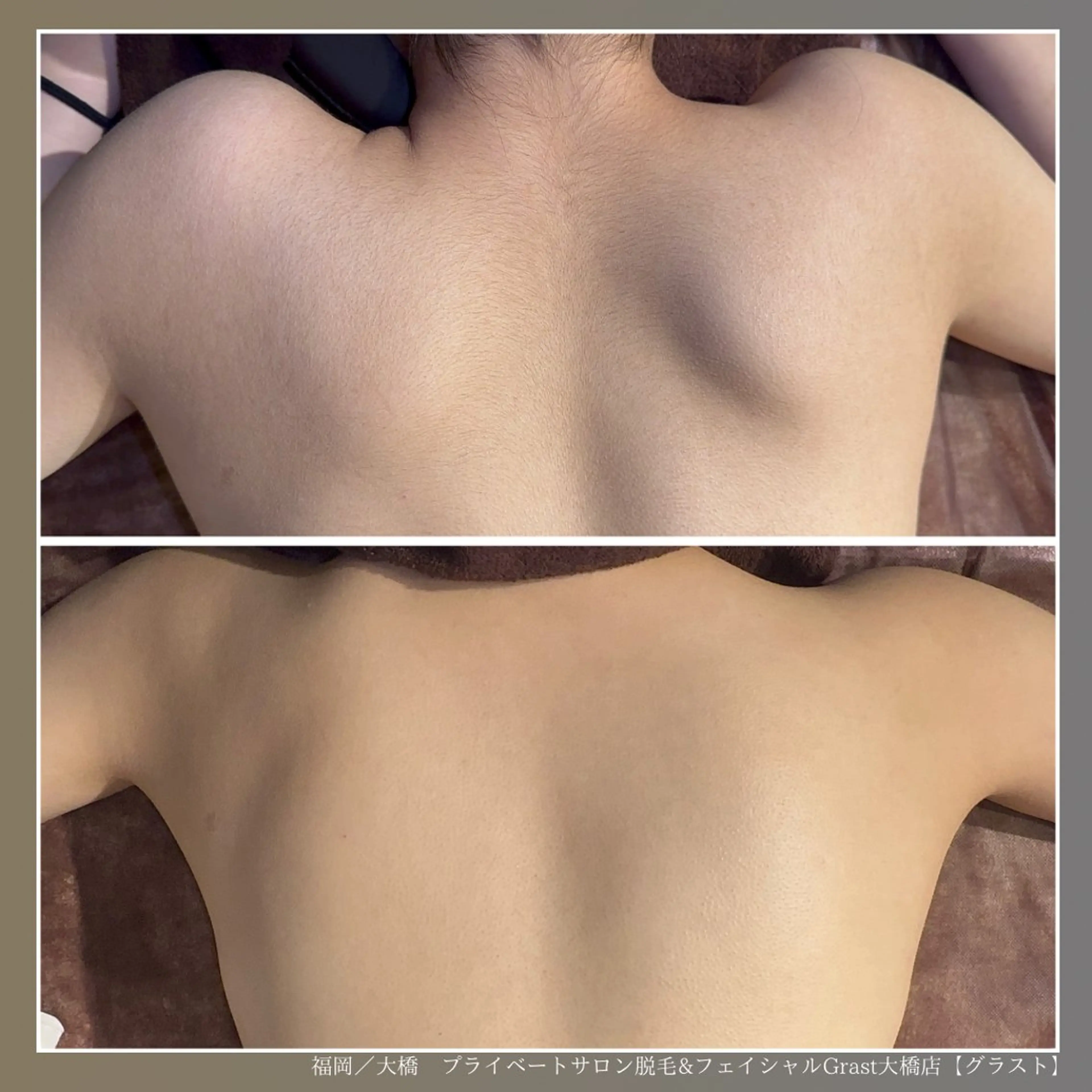 脱毛 ツヤ肌脱毛サロン Grast🌿アイカのエステ・リラクイメージ