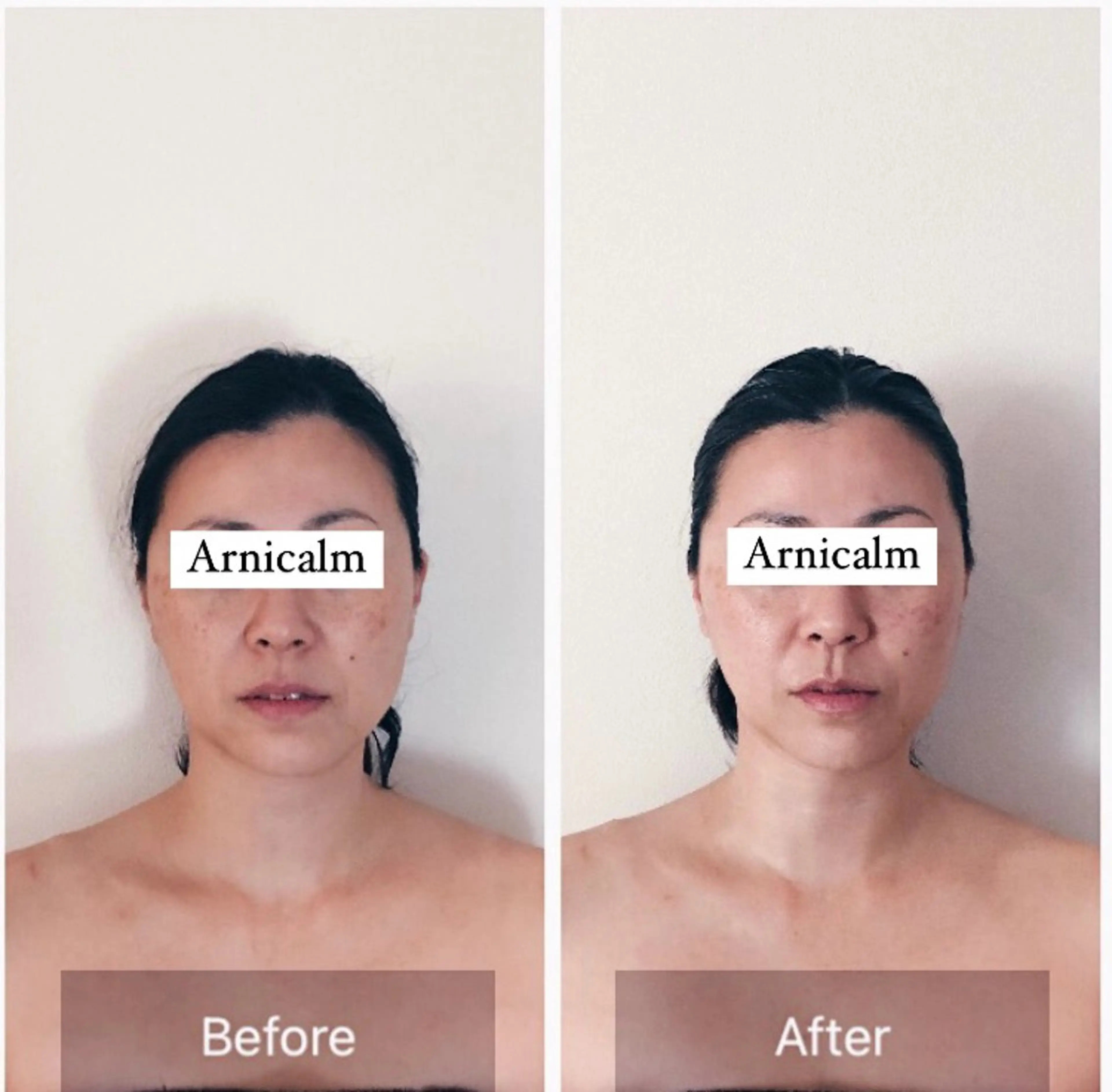 ハーブピーリング 肌再生ピーリング/のエステ・リラクイメージ