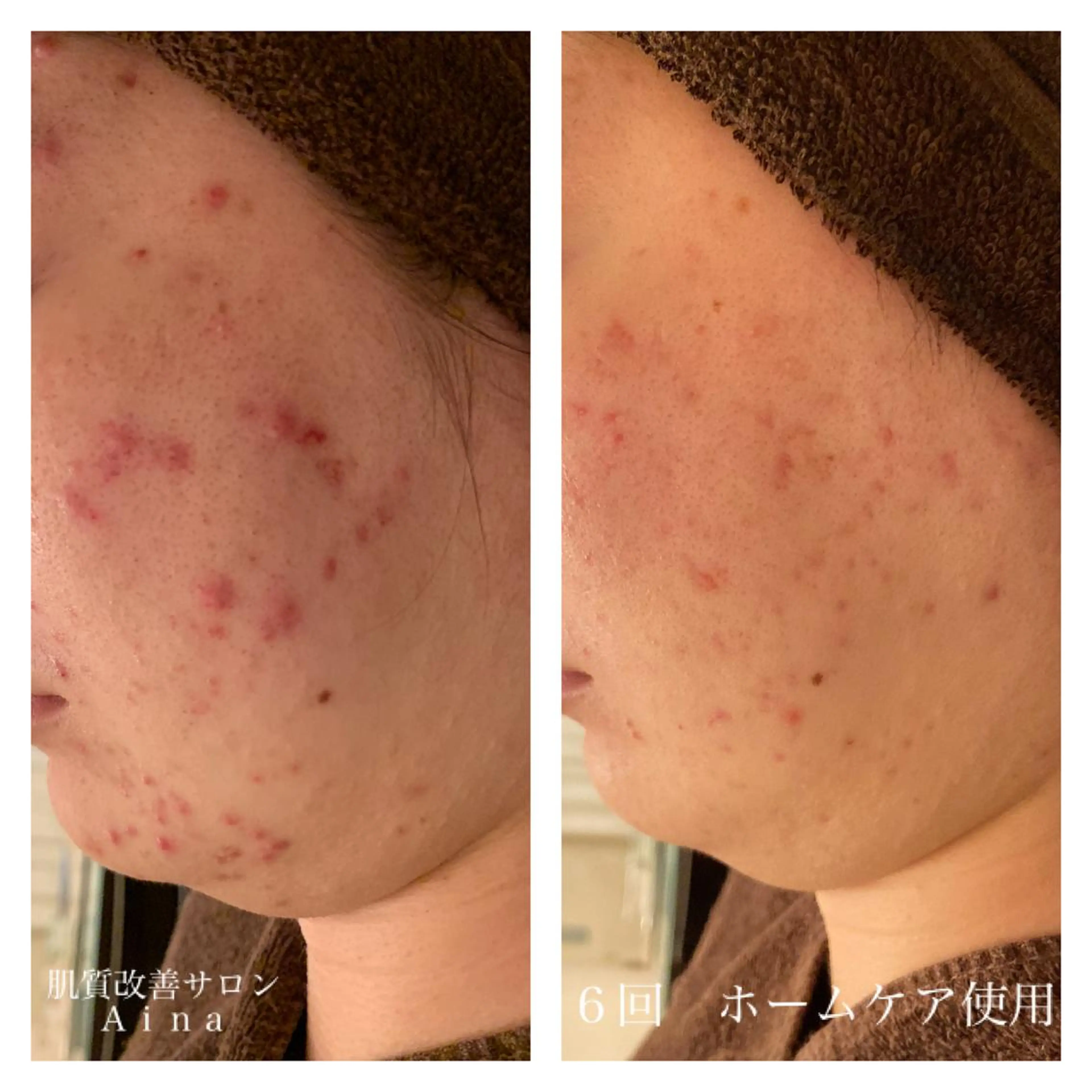 セミロング カラー パーマ ヘアアレンジ メンズ キッズ ネイル マツエク・マツパ 赤色 エステ リラク ニキビ跡専門サロン Ａｉｎａのエステ・リラクイメージ