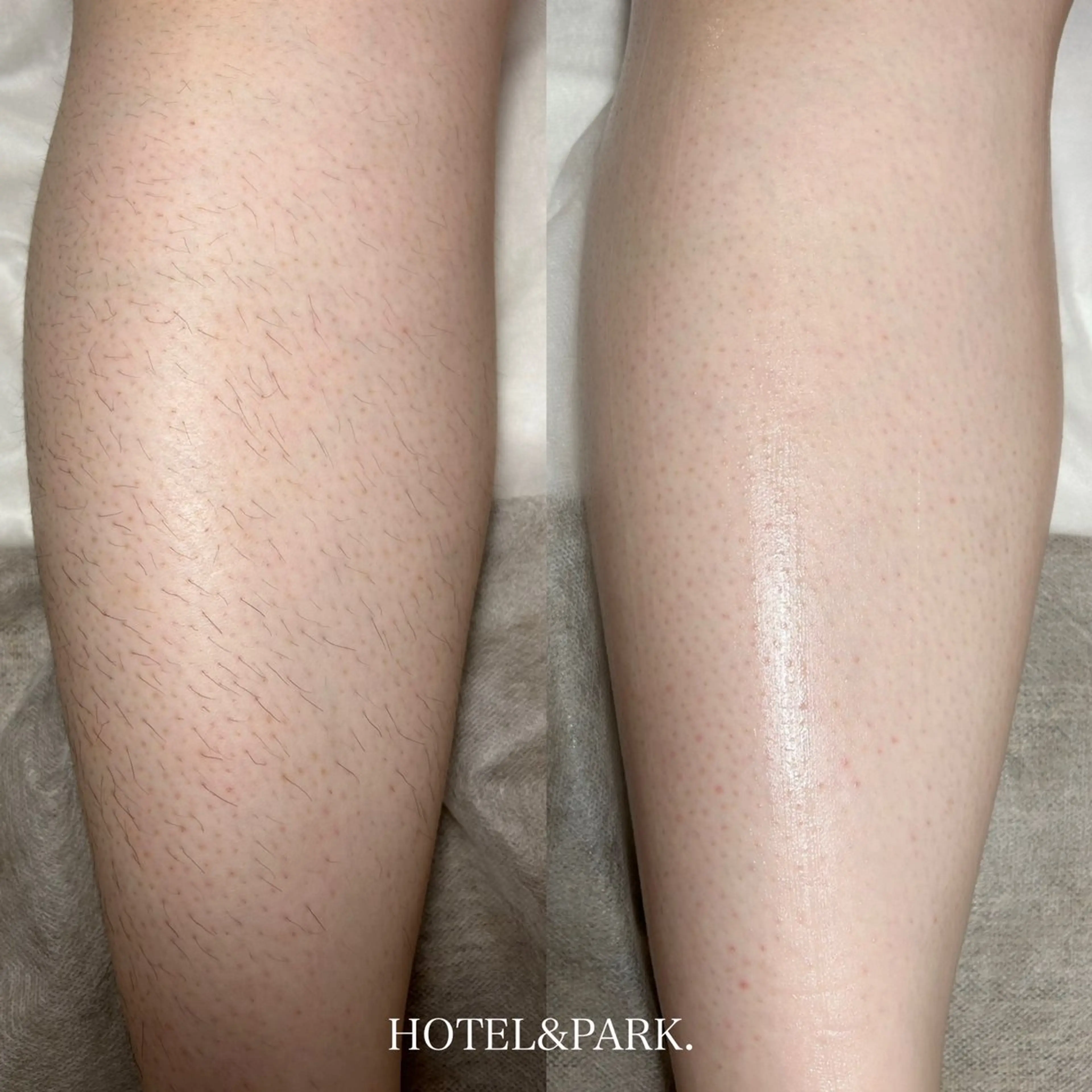 ①【ひざ上orひざ下ワックス脱毛】　　　　　　　　　　　　　技術向上メニューの写真