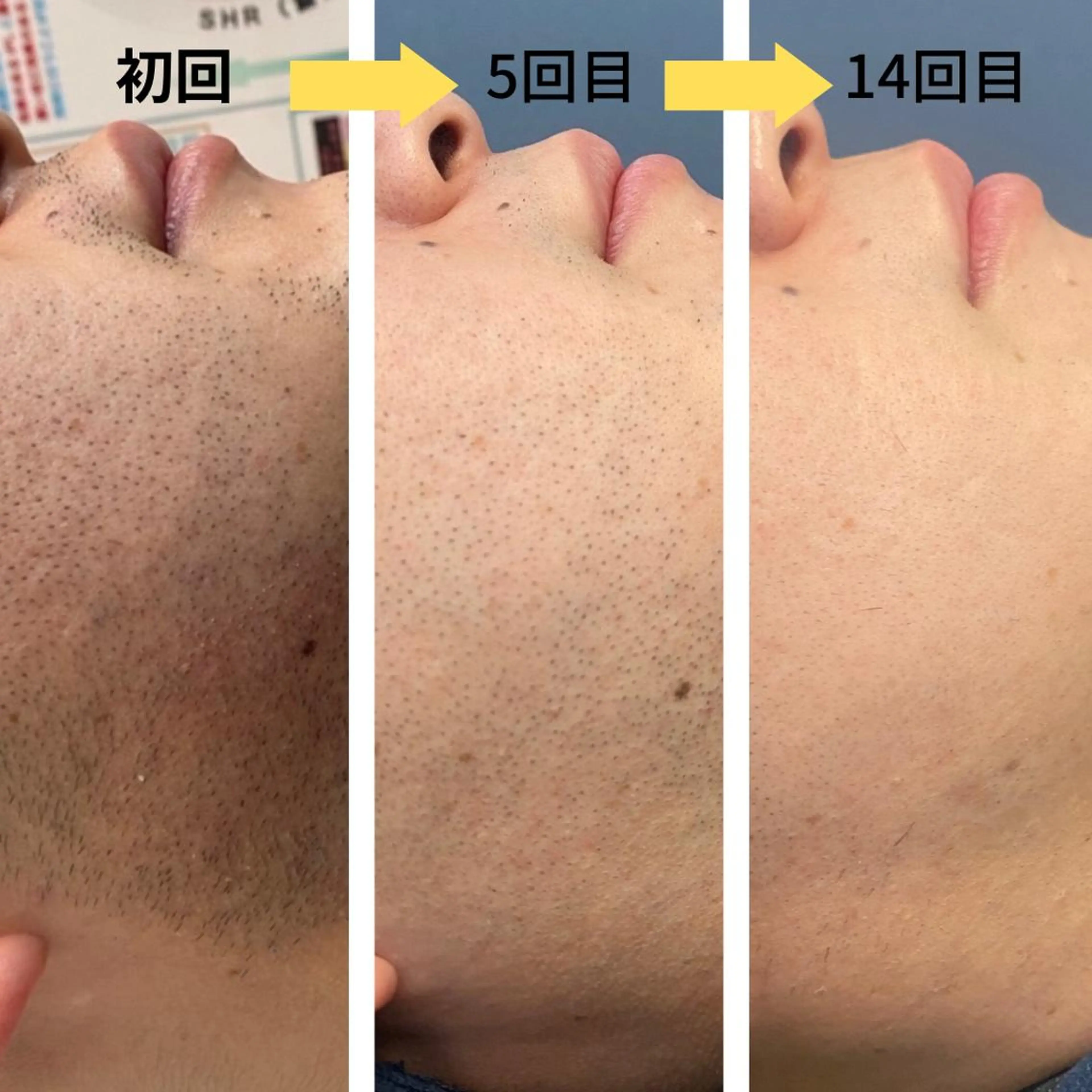 脱毛 シエスタ 山下 上級脱毛士のエステ・リラクイメージ